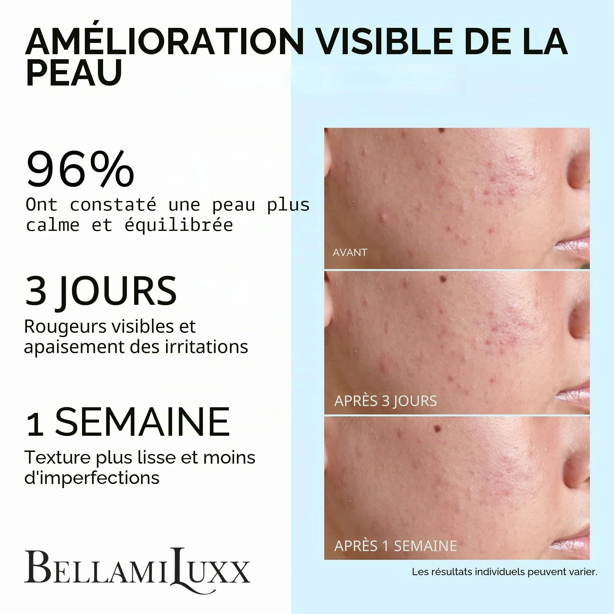 BellamiLuxx Traitement cystique de l'acné pour le visage : crème de traitement de l'acné hormonal pour adolescents et adultes - Acide salicylique et huile d'arbre à thé - Anti-acné hydratant réduit