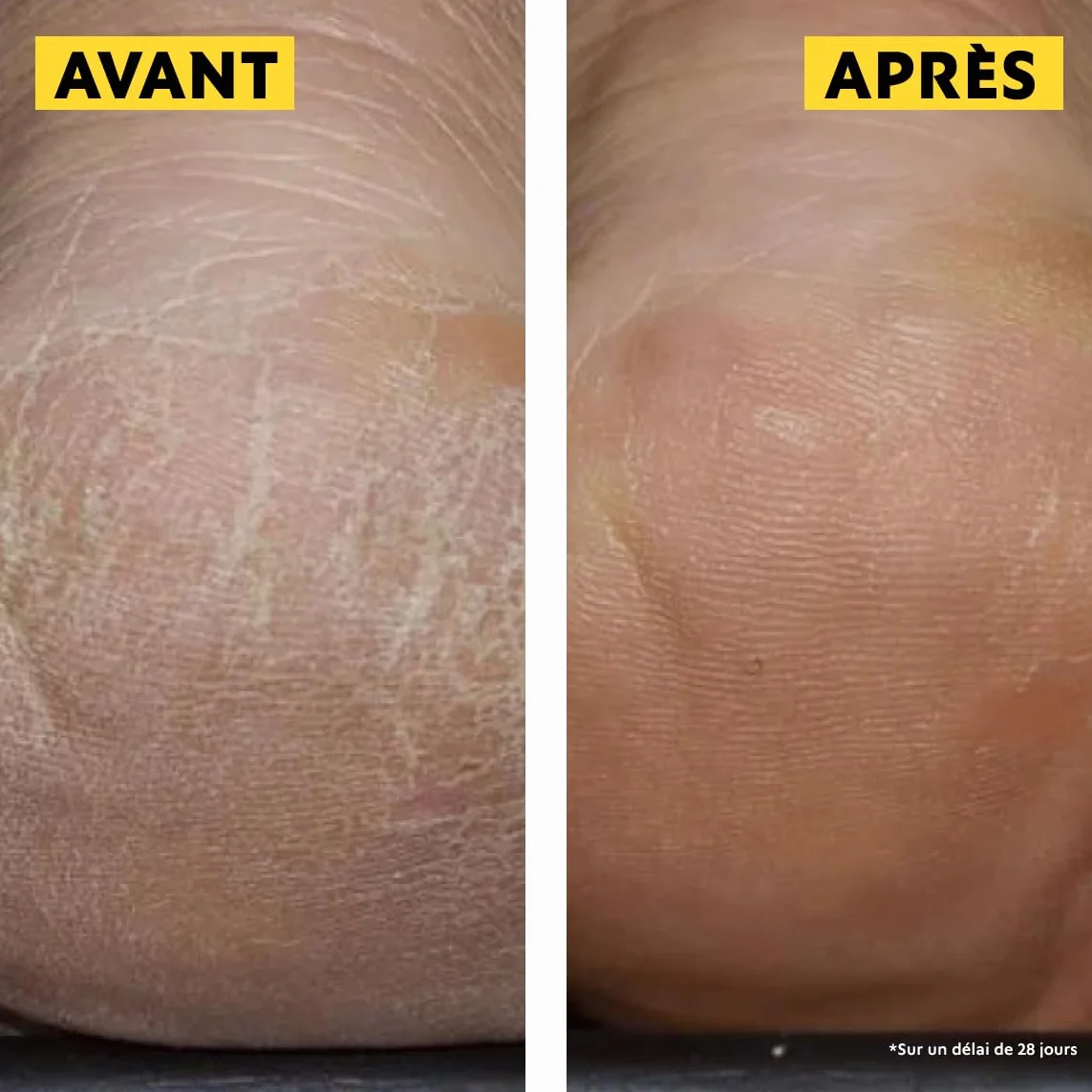 Alvadiem Soin Protection Intense Crème Pieds Très Secs Diabétiques 100 ml
