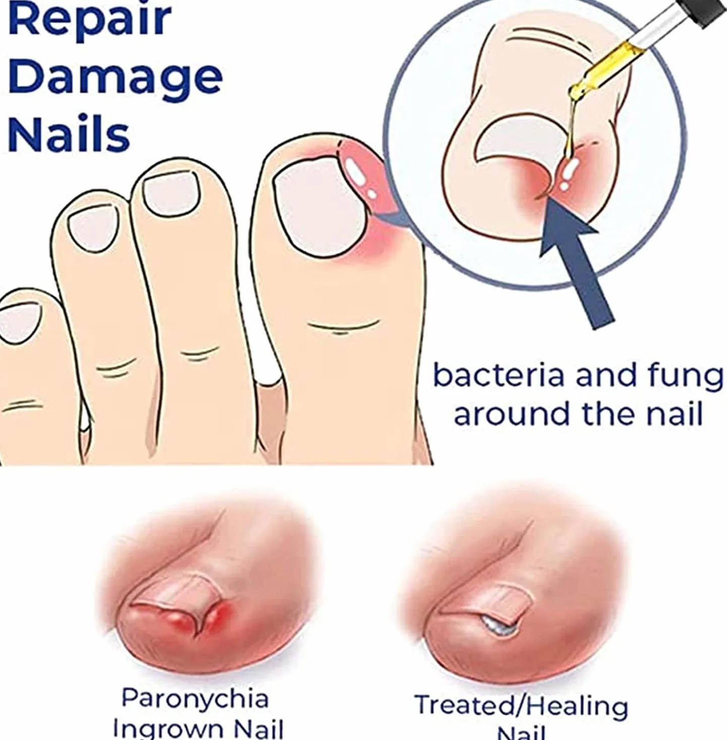 German Toenailplus Anti Paronychia Relief Oil, Paronychia Treatment for Toe and Fingernail Repair (2pcs)
