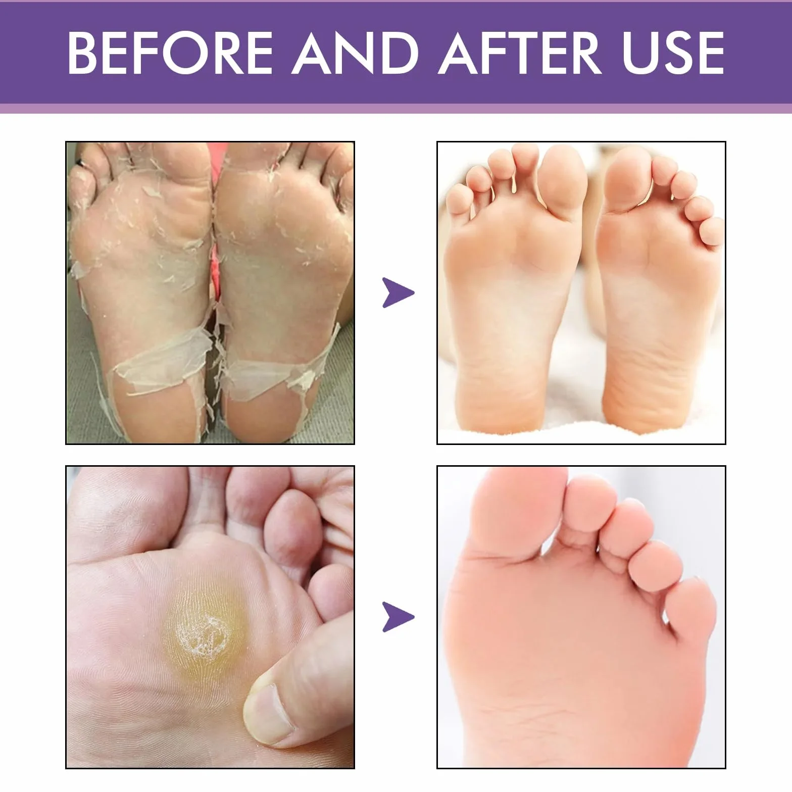 Masque Pied Peeling 5 Paires | Chaussette Exfoliante Pieds Secs Abîmés | Gommage Callus Soin Peau Morte