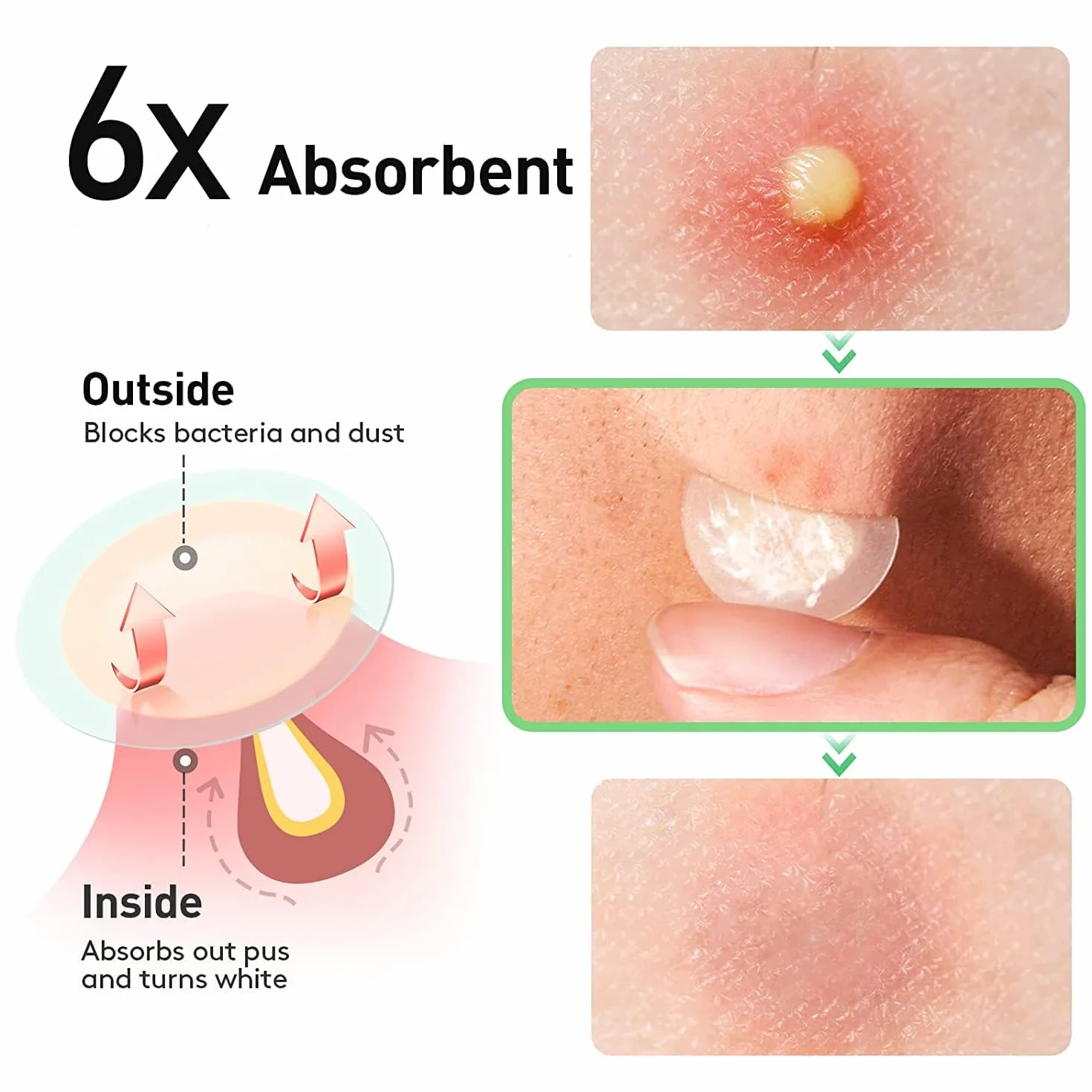 300PCS Acne Pimple Patch Hydrocolloïde Imperméable Invisible 2-En-1 Soins Peau