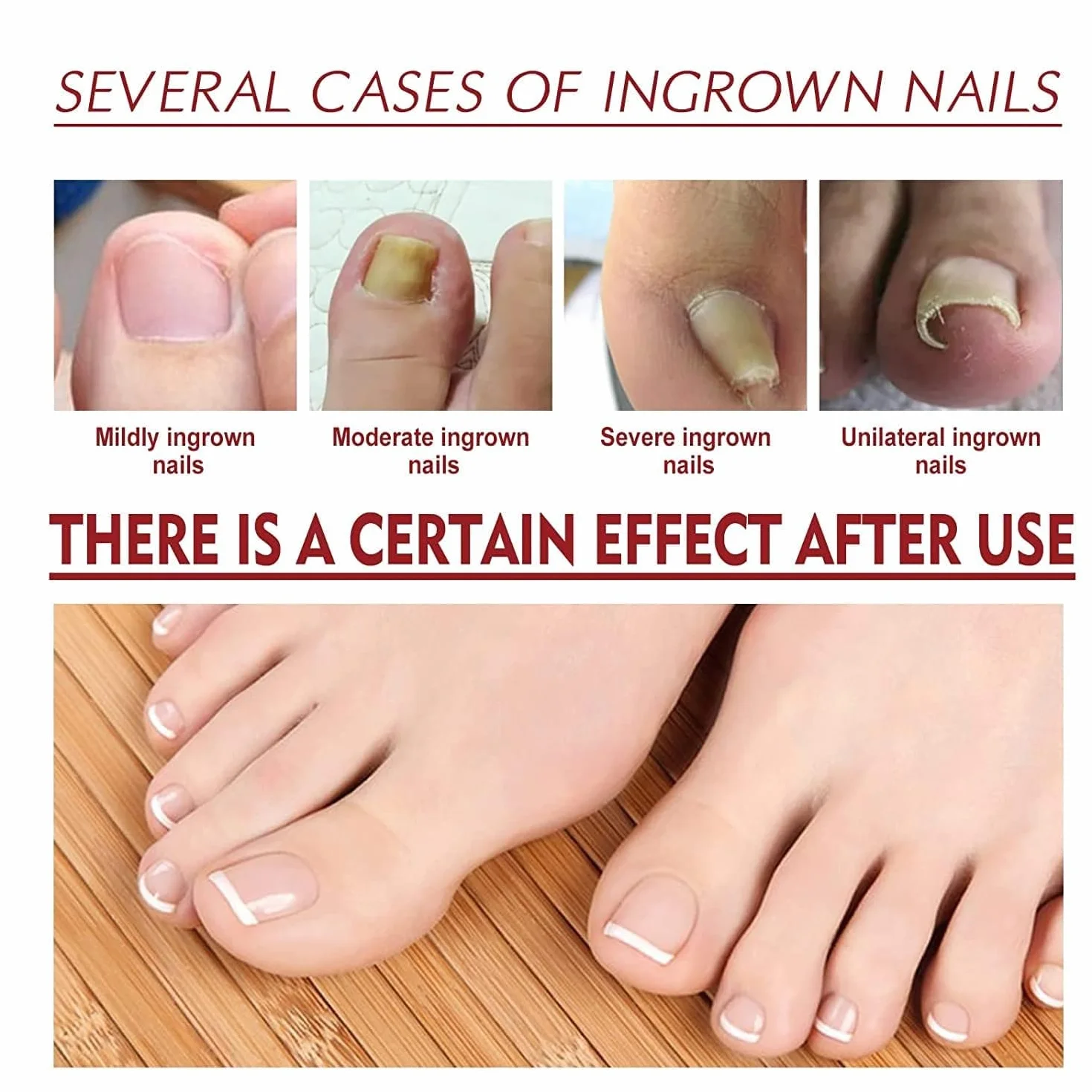 German Toenailplus Anti Paronychia Relief Oil, Paronychia Treatment for Toe and Fingernail Repair (2pcs)