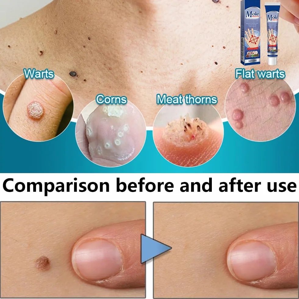 Crème Anti-Verrues et Anti-étiquettes Cutanées 20g