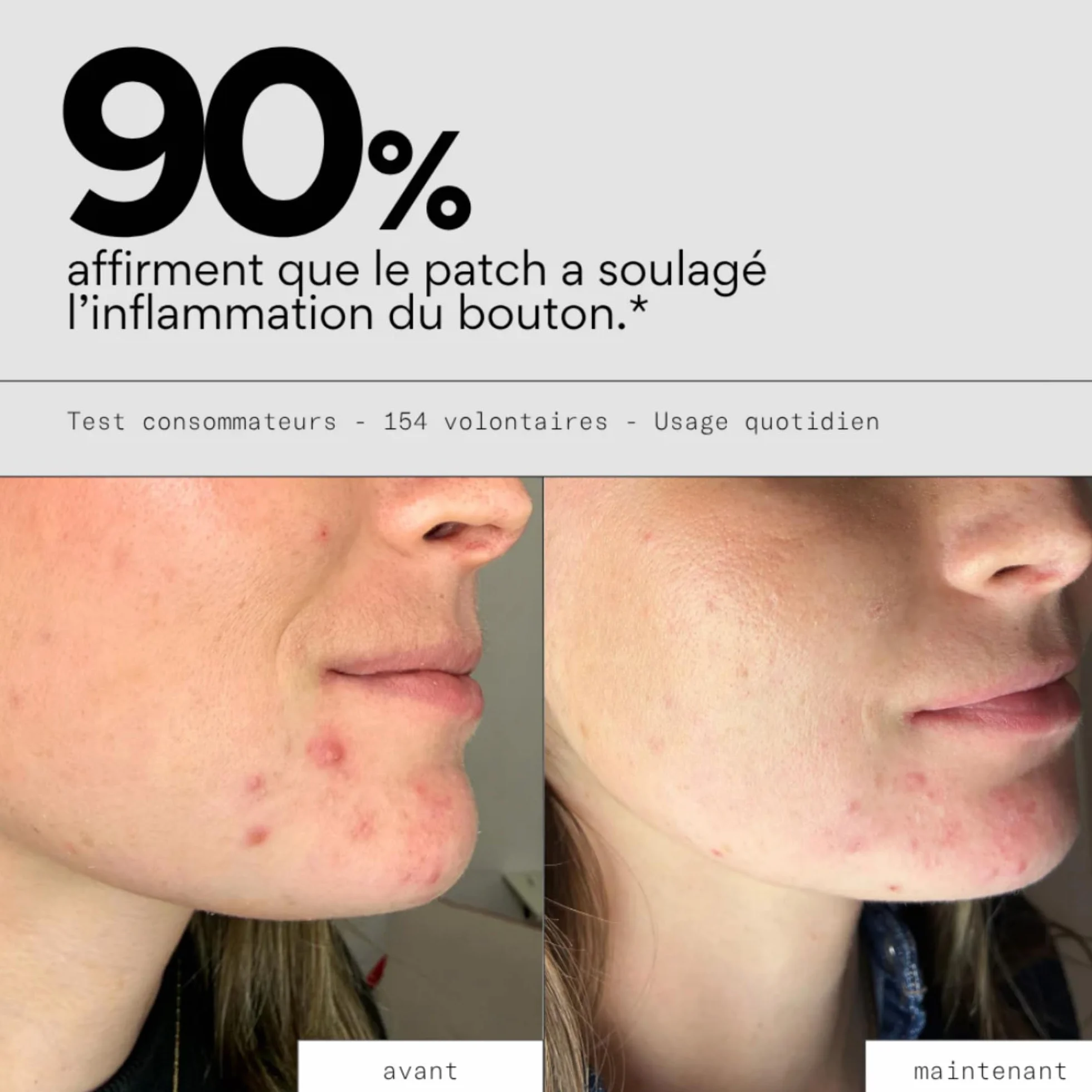 Patchs Boutons XL Hydrocolloïdes Visage Corps Grandes Zones Réduit Boutons Inflammation Vitamine C Acide Salicylique Vegan