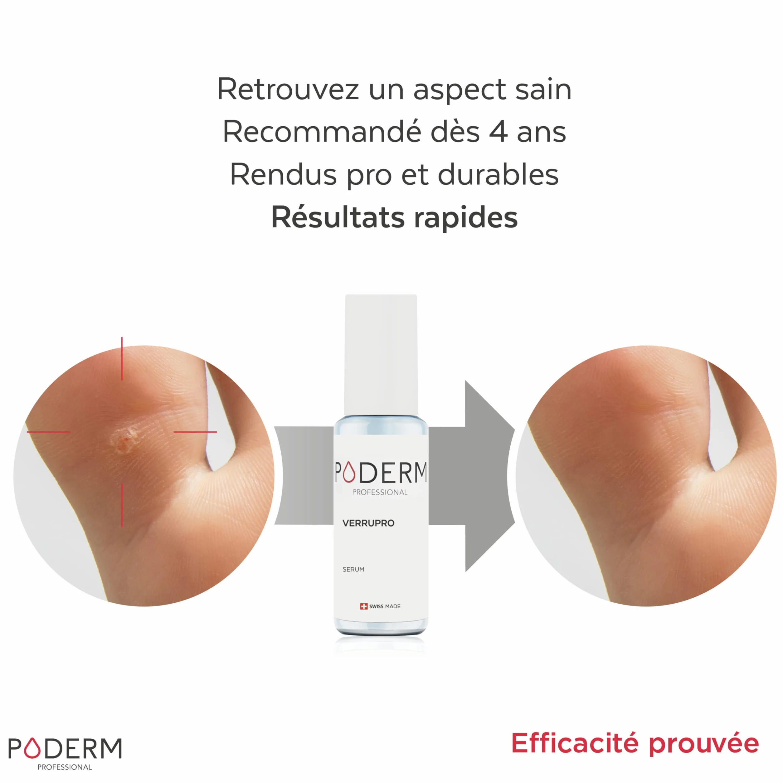 PODERM VERRUPRO SOLUTION PIEDS-MAINS Huile Sérum 100% Naturels Swiss Made