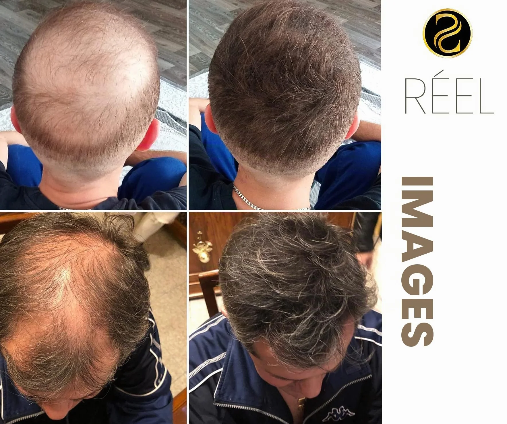 Fibres capillaires densifiantes – Densificateur de cheveux – Effet densité naturel – Pour cheveux fins et clairsemés - brun fonce - 25g