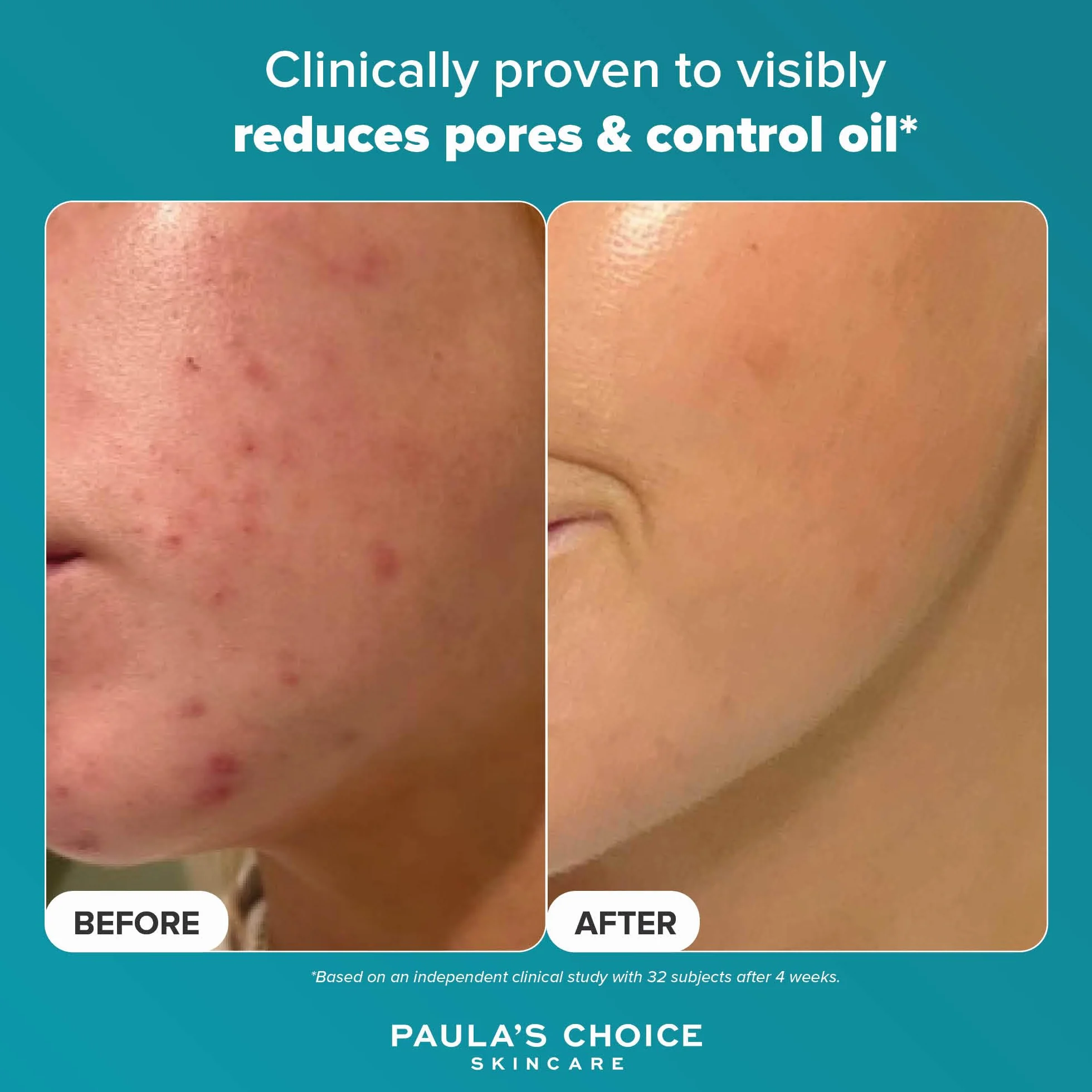 Paula's Choice Anti-Imperfections Réduit les Imperfections Pores Dilatés Taches Brunes Acide Salicylique Azélaïque Tous Types de Peaux Format Voyage