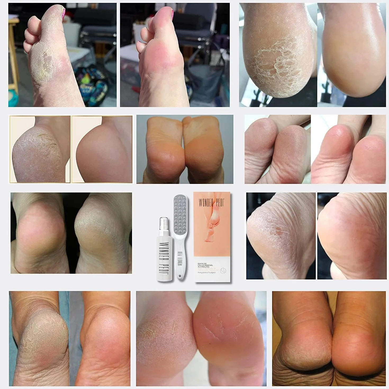 Détachant les callosités - Fixation rapide en trois minutes - Râpe pour les pieds - Exfoliant instantané pour les pieds - Spray exfoliant instantané - Lime à récurer les callosités - Traitement de