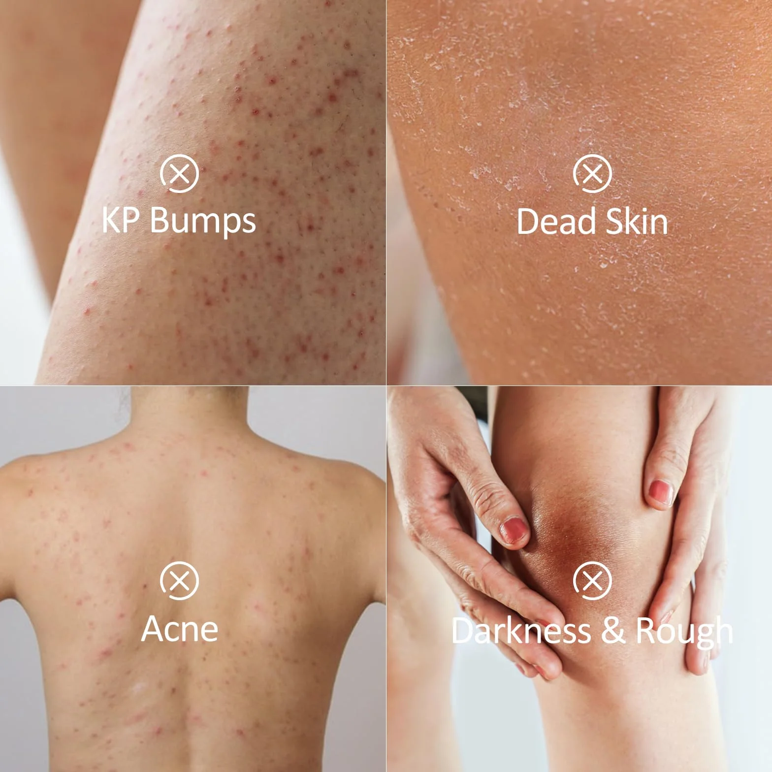 Gommage Corporel Kp Bump Eraser pour Kératose Pilaire Jambes à la Fraise Acide Salicylique AHA Exfoliant Corporel Kp Peau de Poulet