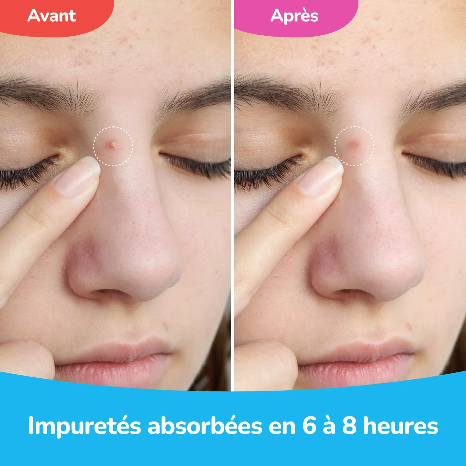 Patch Bouton Invisible Nuit & Jour Soin Visage Absorbe Impuretés Lisse Peau Technologie Hydrocolloïde Acide Salicylique 72 Patchs