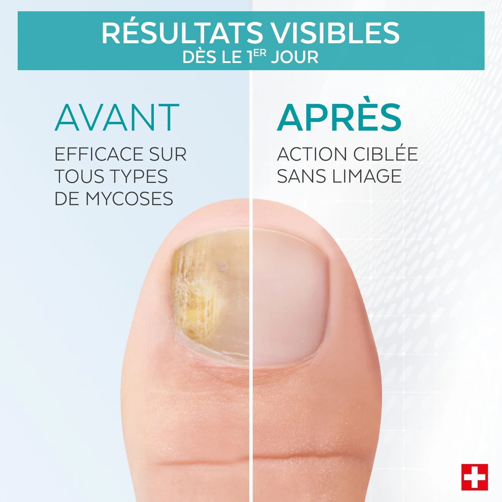 PODERM Stylo Mycose Ongles Des Pieds 4ML – Formule Vegan | Traitement 3en1 Elimine la Mycose | Nail Care Pen | 3 Secondes Par Jour et Résultats Rapides | Créé Par Une Podologue - Fabriqué en Suisse