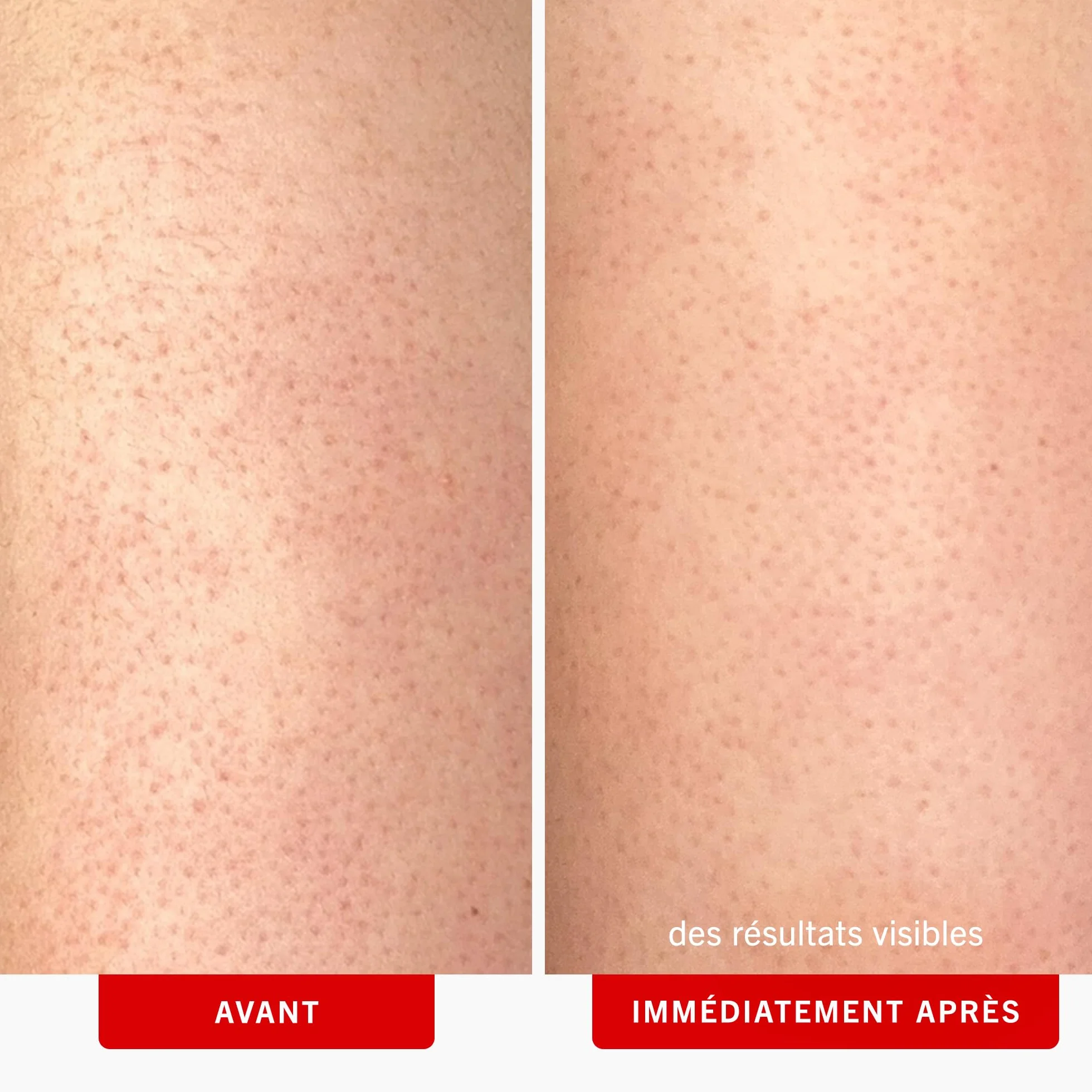 First Aid Beauty Gommage corporel KP Bump Eraser 10% AHA exfoliant kératose pilaire glycolique lactique