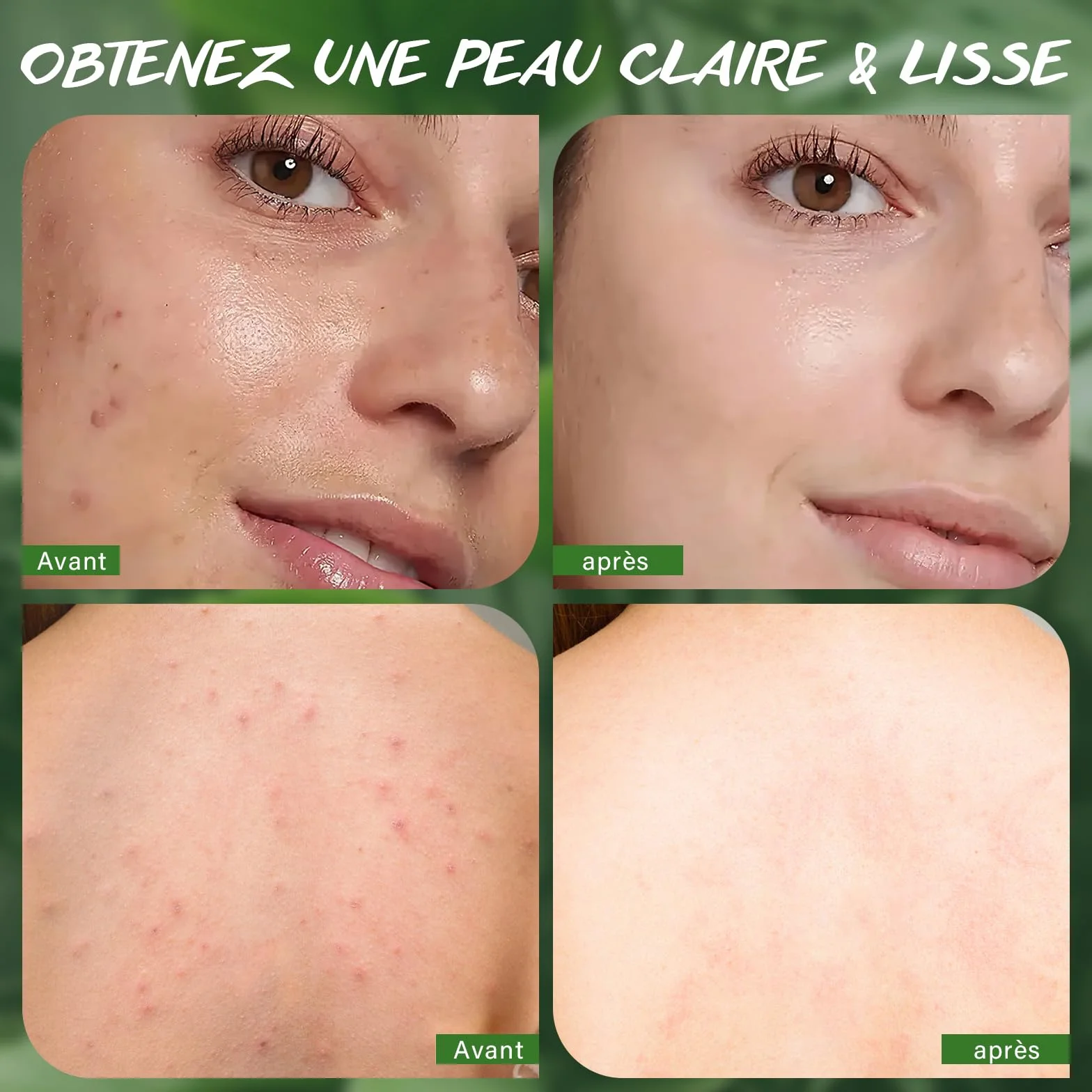 Savon à L'Huile d'Arbre à Thé 3x100g Naturel Contre Mycoses Cutanées, Transpiration, Odeurs, Démangeaisons, Acné, Pied d'Athlète