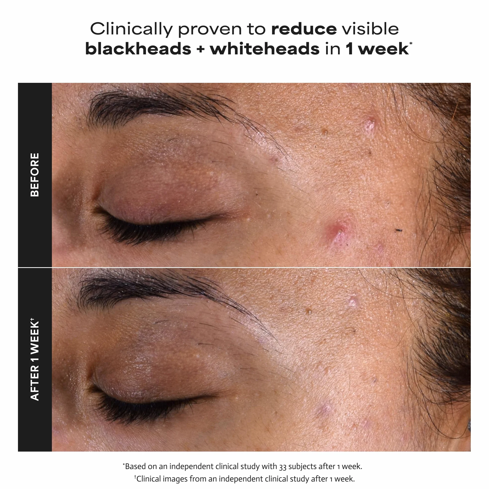 Paula's Choice SKIN PERFECTING 2% BHA Lotion Exfoliante Acide Salicylique 30 ml