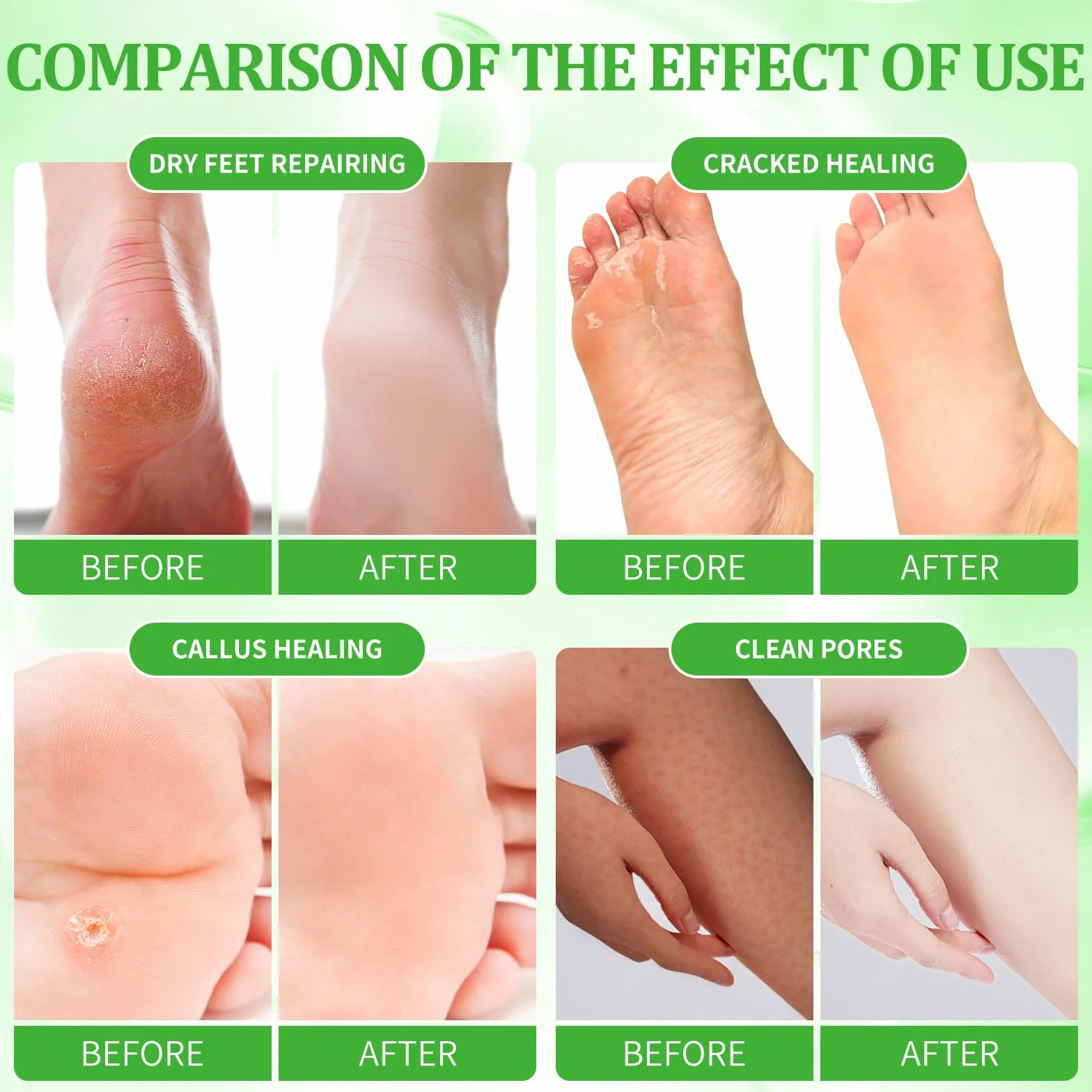 Kit de trempage des pieds : sel bulle, gommage au sucre, masque de massage, lotion de massage dans une boîte, kit spa 4 étapes pour pieds secs, adoucit les callosités, pieds fatigués (3