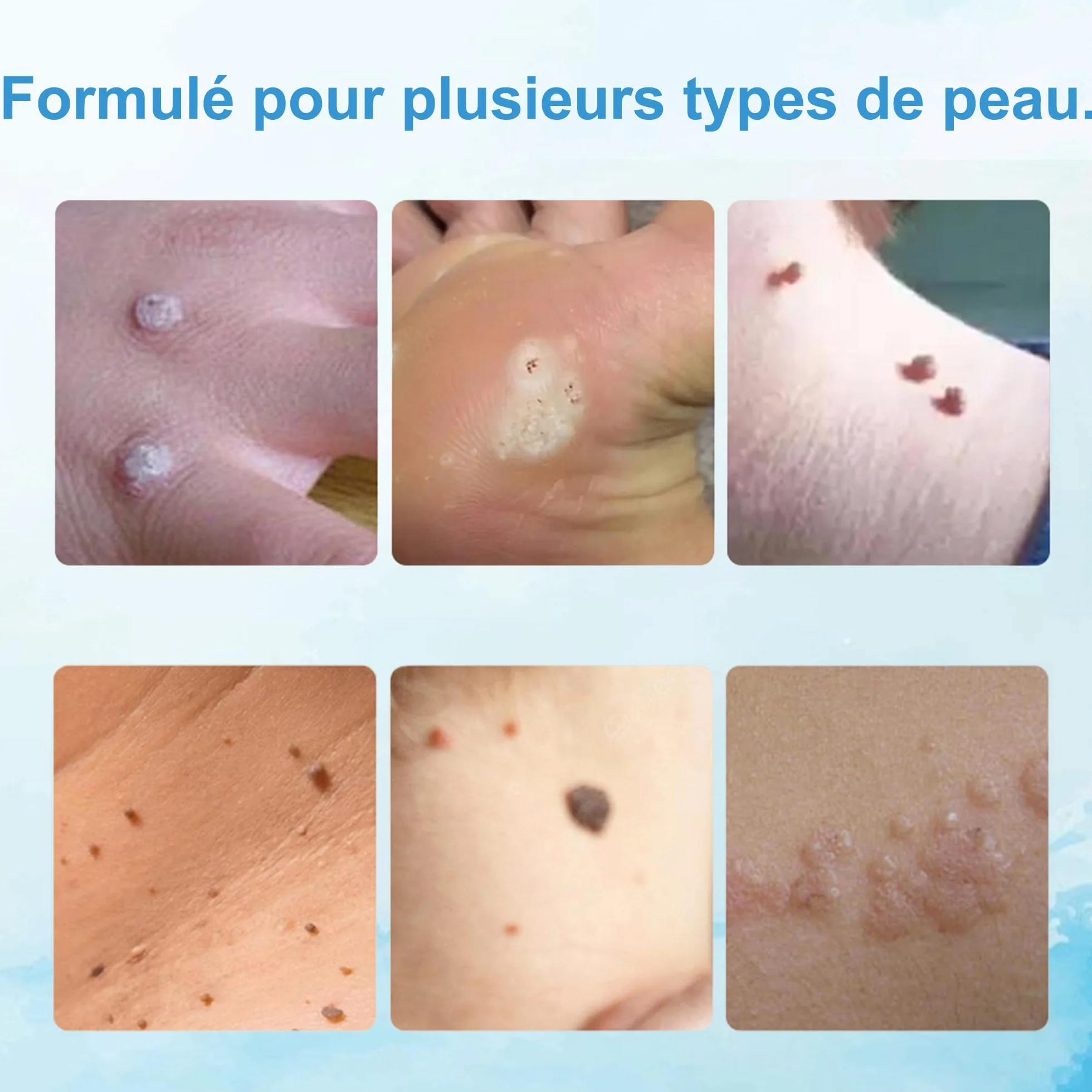 Crème Anti Verrue 20g Élimination Verrues Plantaires Vulgaris Cors Planes