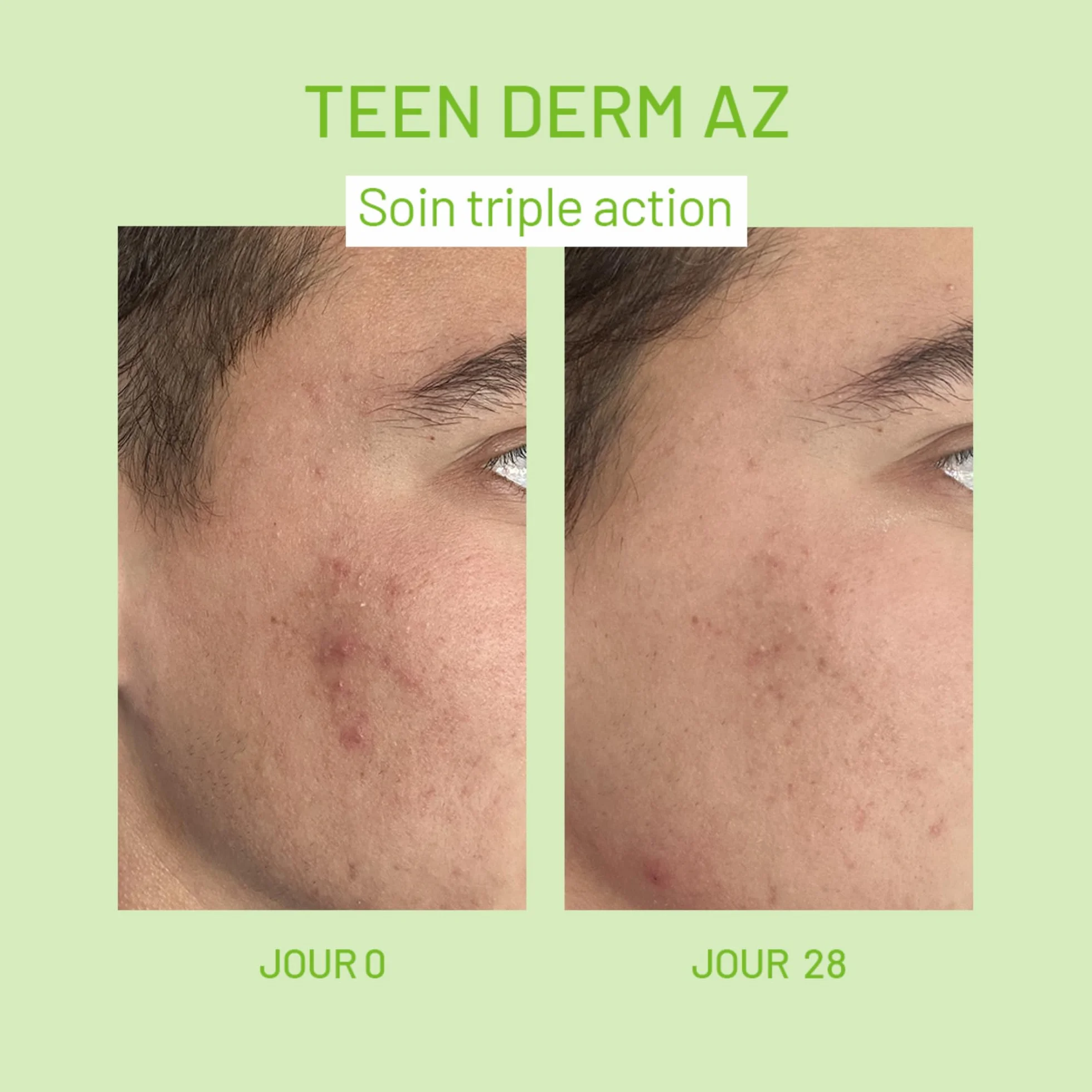 ISISPHARMA TEEN DERM A.Z Soin Triple Action Anti-Imperfections Peaux Mixtes à Grasses 15% Acide Azélaïque Fabrication Française