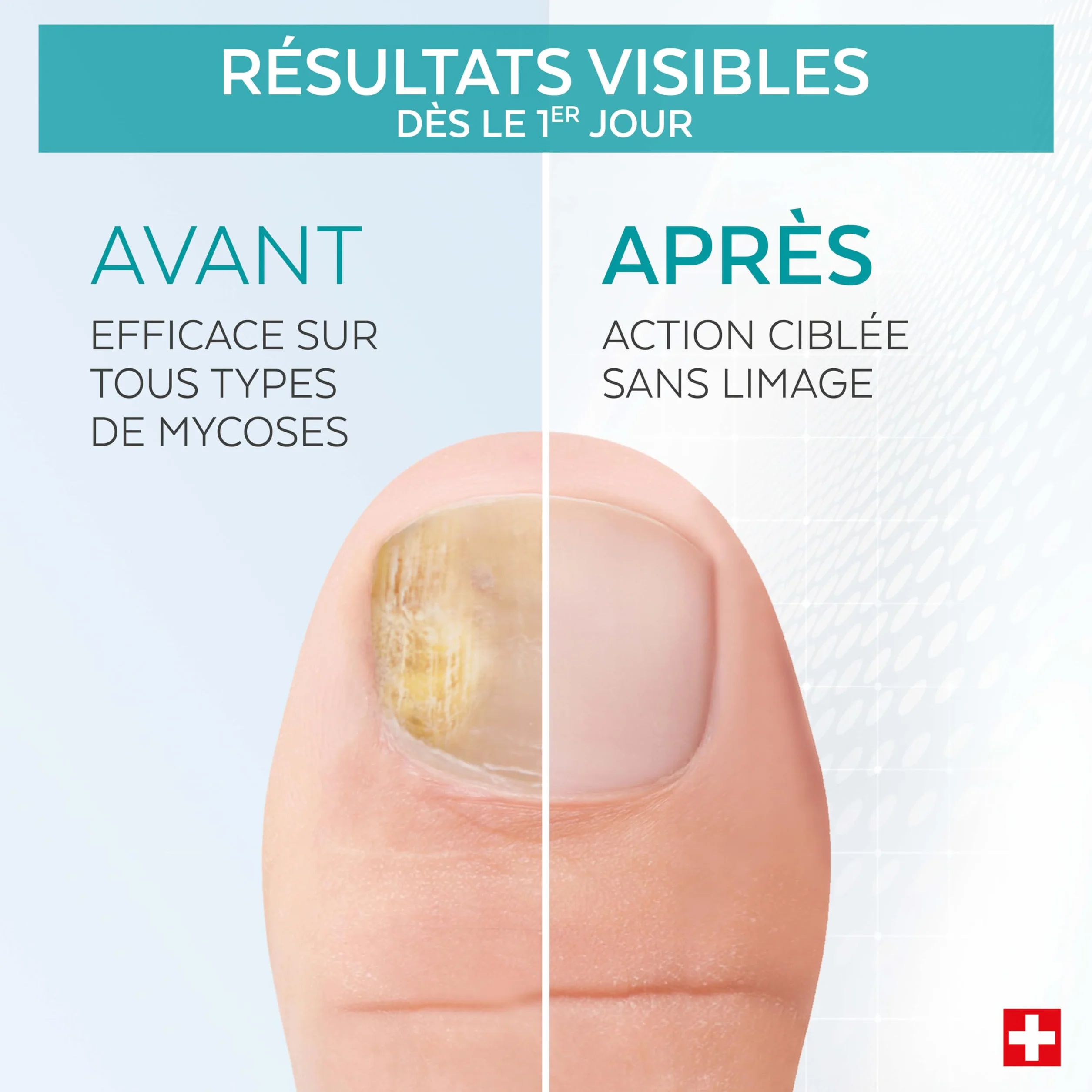 PODERM MYCOSE ONGLE TRAITEMENT 2en1 Antifongique Réparateur Pied Main Swiss Made