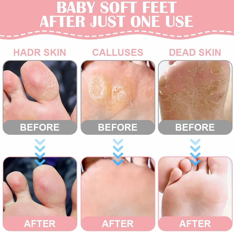 Masque Pieds Peeling Exfoliant 4 Paires Saveur Rose, Chaussette Exfoliante Hydratante pour Callosités et Pieds Secs