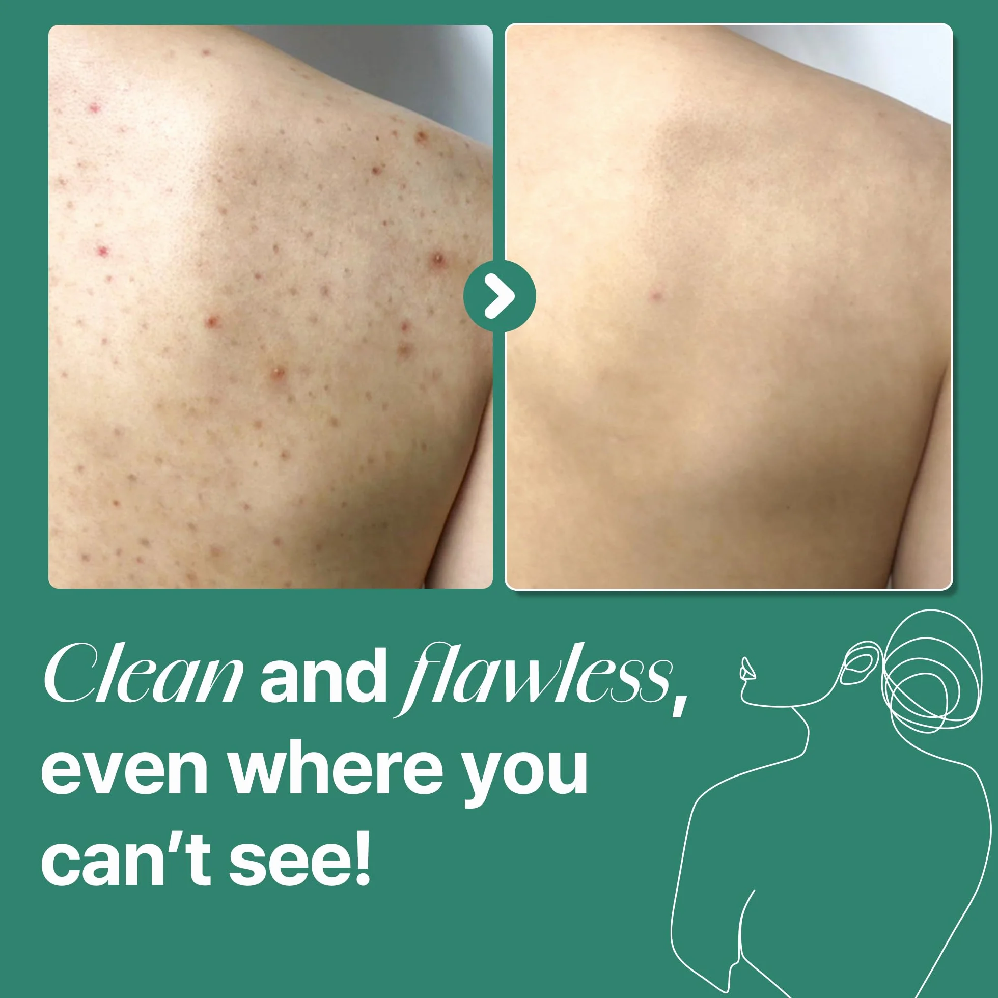 SOME BY MI AHA BHA PHA 30 Days Miracle Acne Clear Body Cleanser 400ml Gel douche exfoliant au tea tree