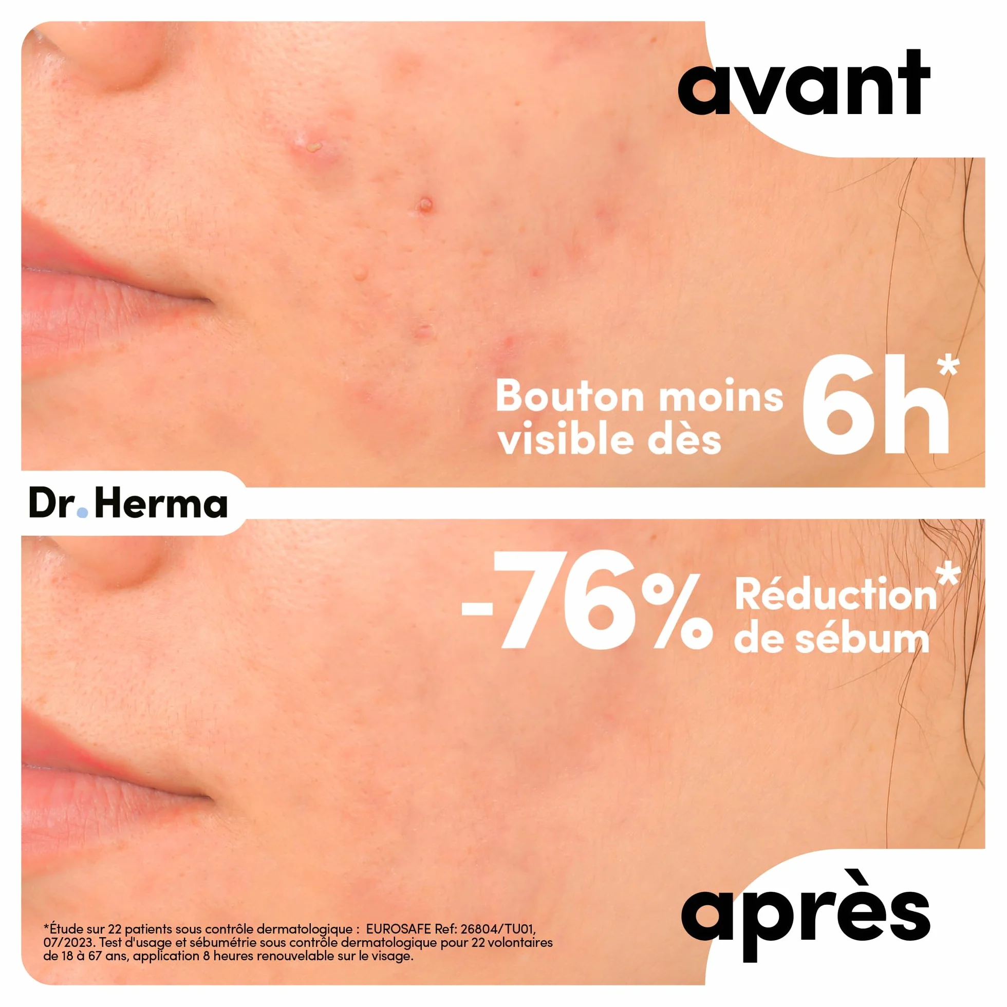 Dr. Herma Patch Anti Bouton XL Acide Salicylique Hydrocolloïdes Huile d'Arbre à Thé 10 patchs