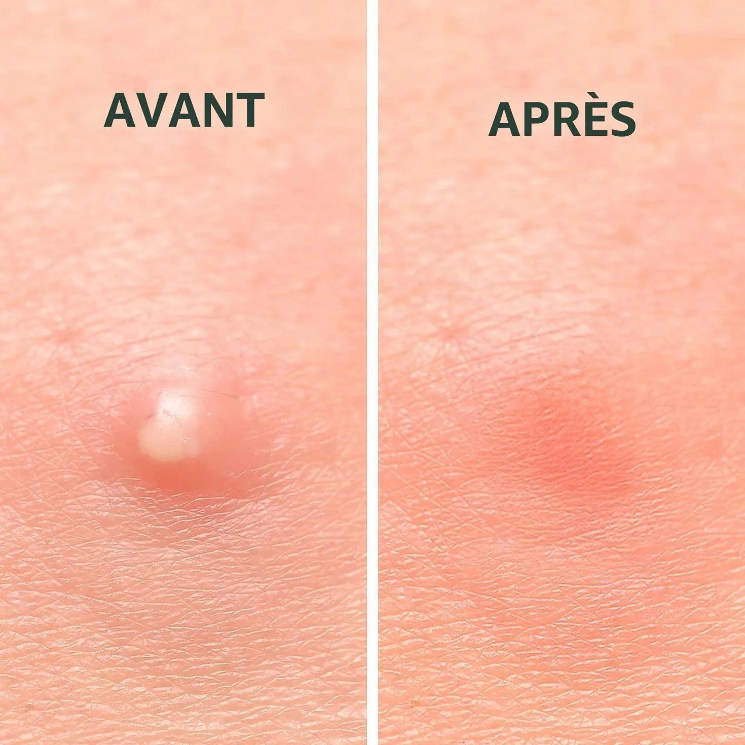 Rael Patch Anti Bouton Invisible - Hydrocolloïdes Acne Pimple Patches pour Visage, Vegan, Sans Cruauté, 96 Patchs