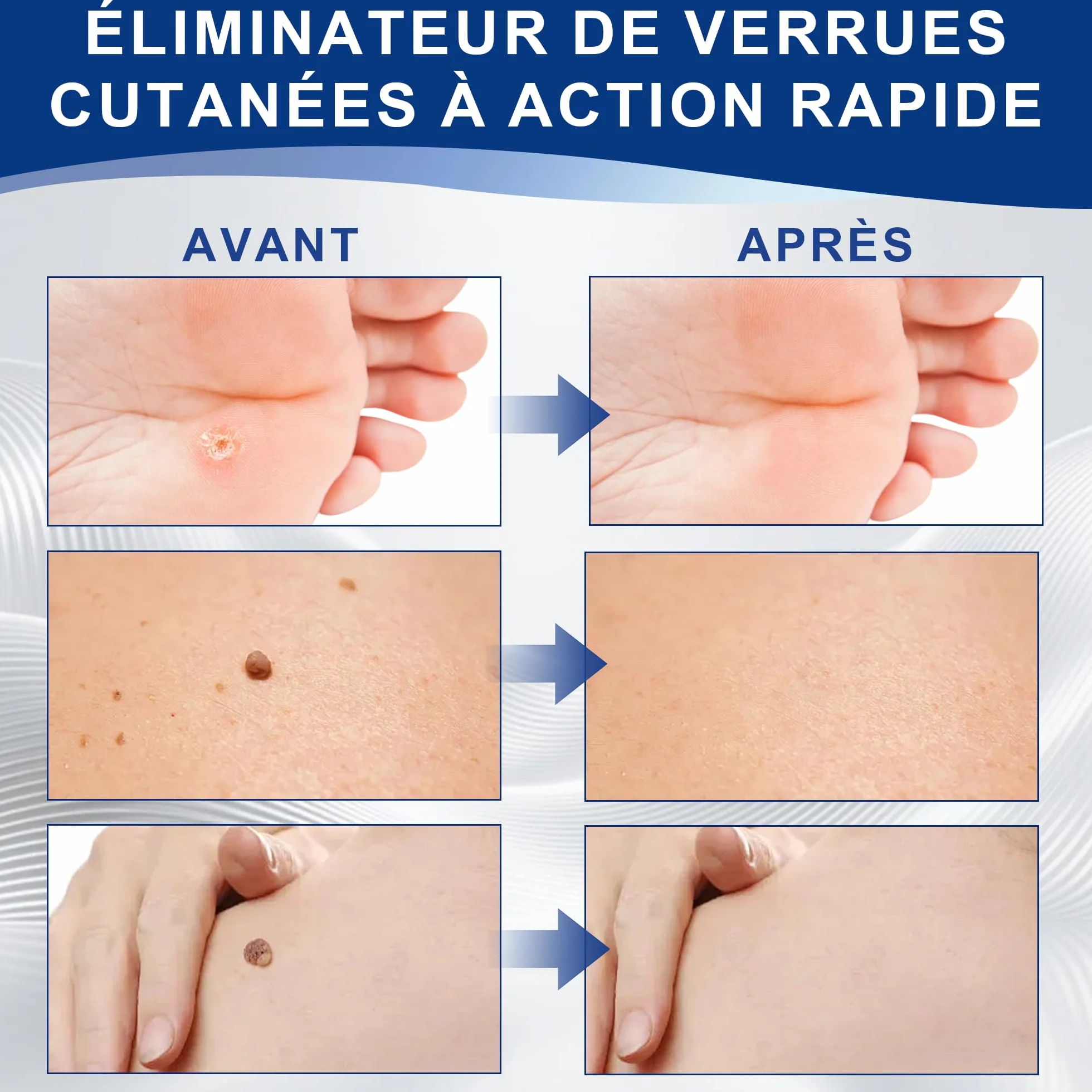 Action Enlèvement Des Acrochordons – Pipette Précision Visage & Corps | Élimination Ciblée des Verrues Plantaires, Vulgaire et Plates | Formule Douce à, Format Voyage(10ml)