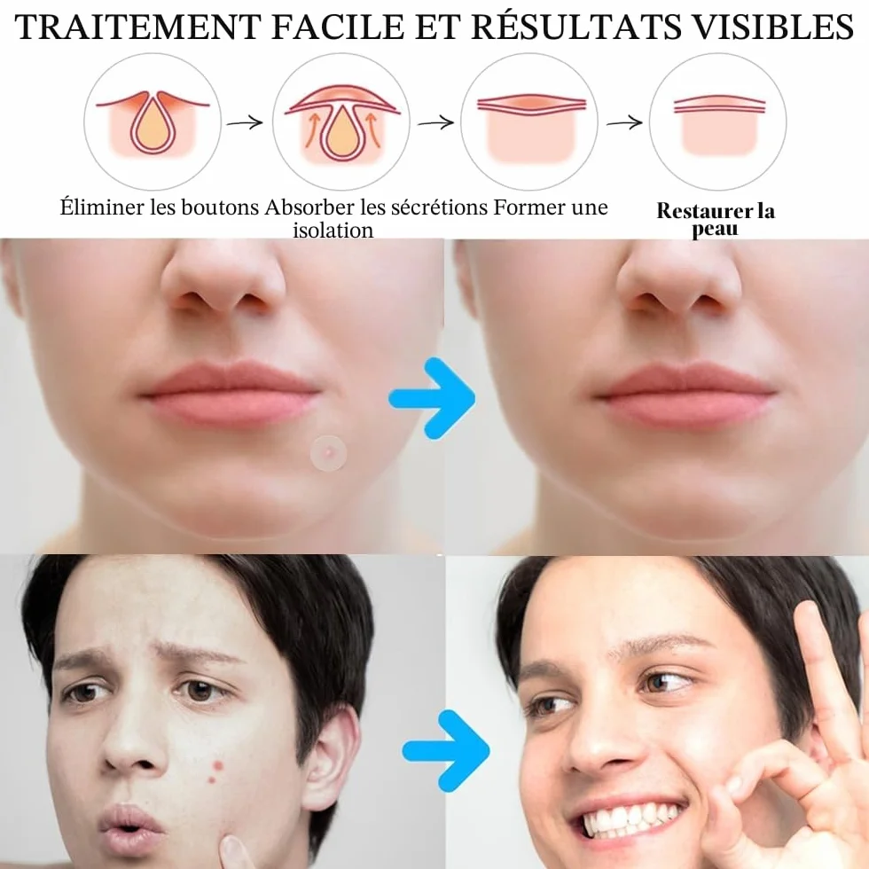 Patch Acne Pimple Anti-Acné Imperméable Autocollants Hydrocolloïde 300PCS