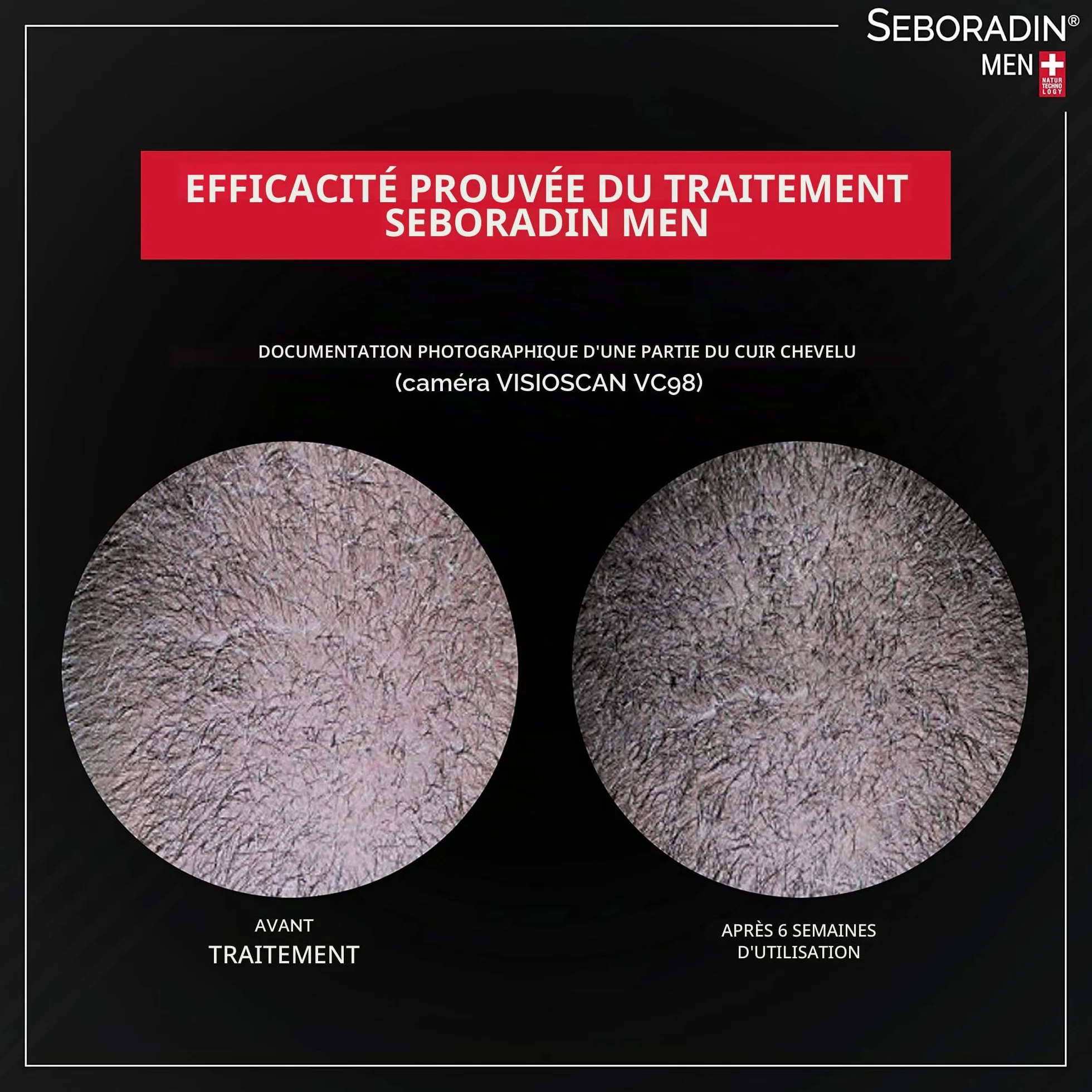 Seboradin Ampoules FORTE Anti-chutes Traitement Intensif Calvitie 14x5,5 ml Hommes