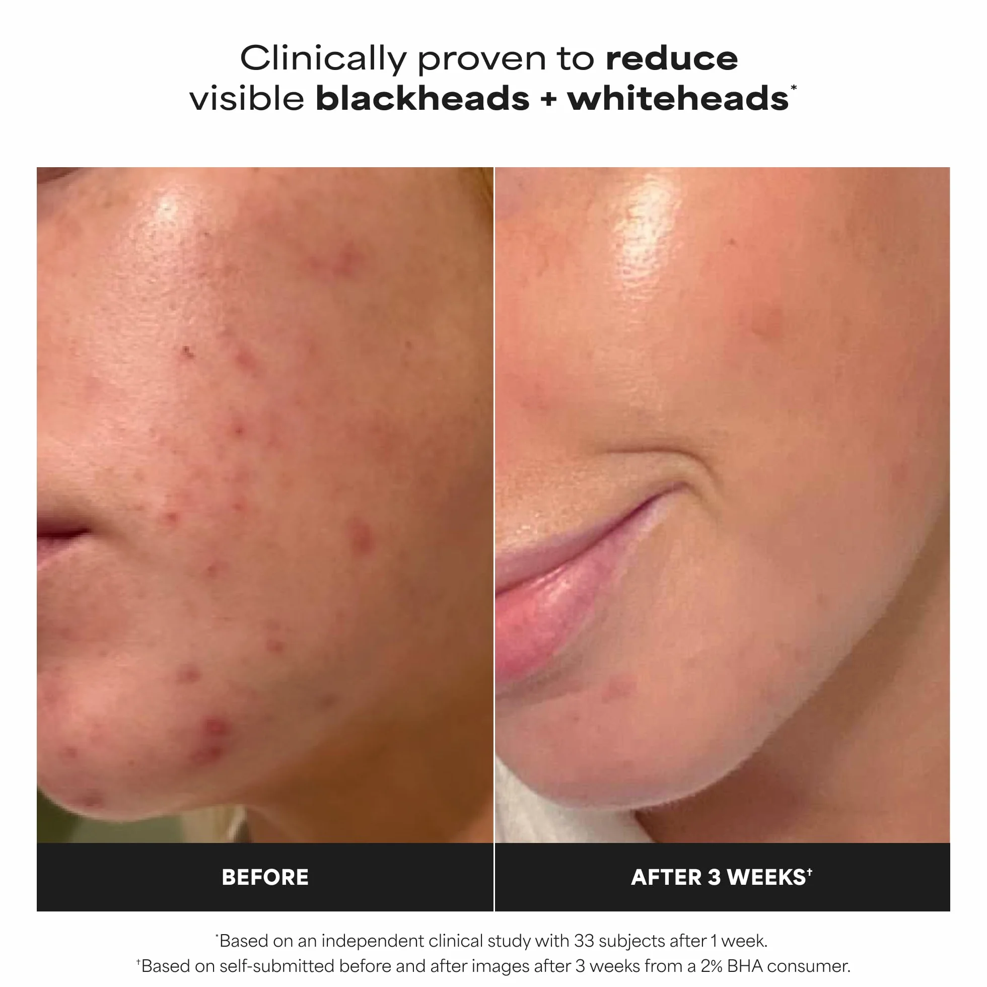 Paula's Choice SKIN PERFECTING 2% BHA Lotion Exfoliante Acide Salicylique 30 ml