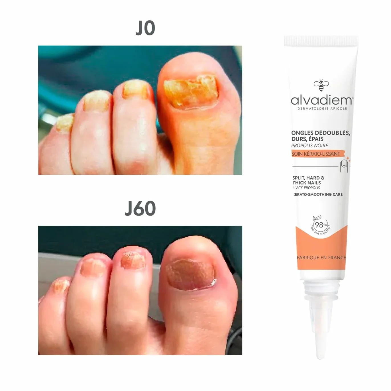 Alvadiem | Soin Ongles Kérato-Lissant à la propolis noire | Ongles durs, épais, psoriasis | Affine & restructure les ongles durs & épais | Lutte contre l’oxydation | Fabriqué en France | 10ml