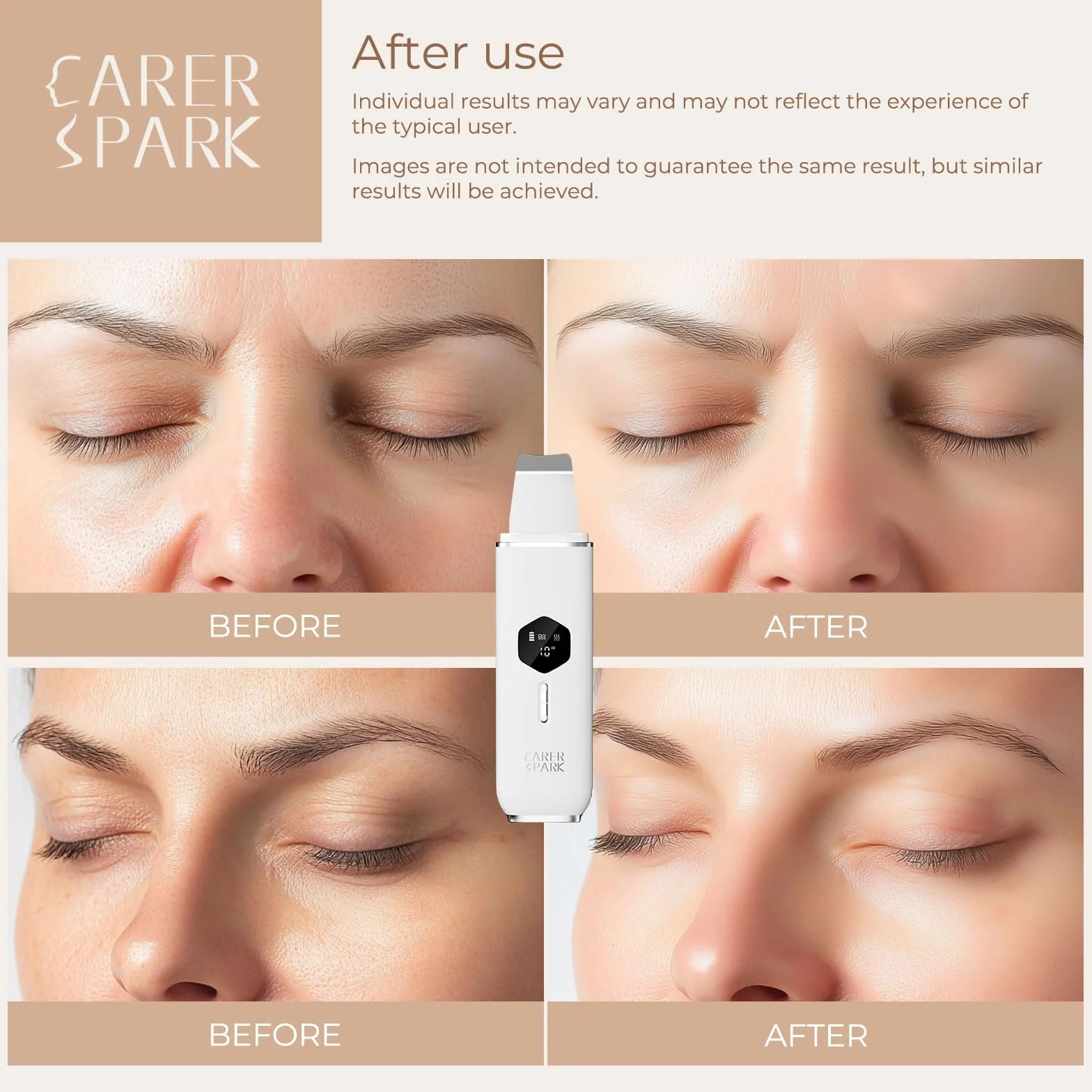 CARER SPARK Épurateur de Peau à Ultrasons,Nettoyeur de Peau Ultrasonique avec 4 Modes écran LED Appareil de Nettoyage Point Noirs Nettoyage en Profondeur Élimination des Points Noirs Exfoliation Douce