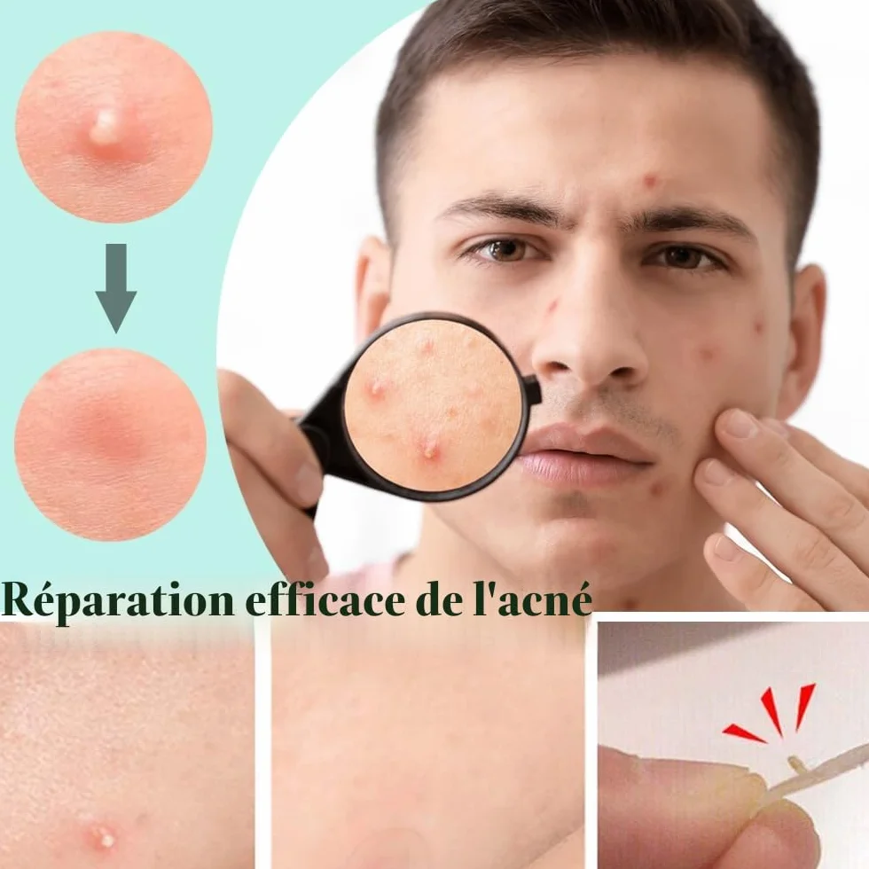 Patch Acne Pimple Anti-Acné Imperméable Autocollants Hydrocolloïde 300PCS