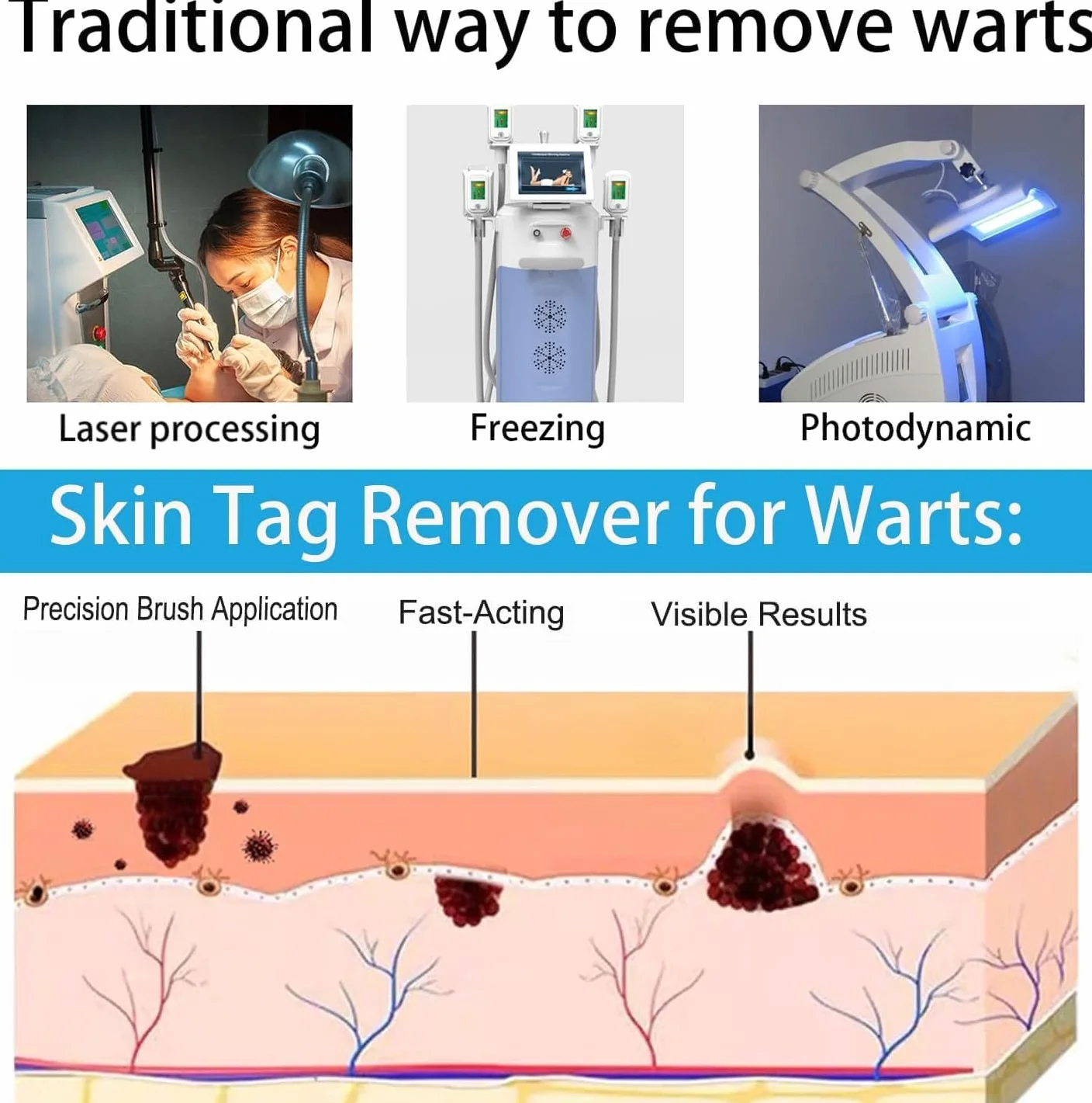 Crème anti-verrues 20g pour acrochordons et petites verrues mains et pieds
