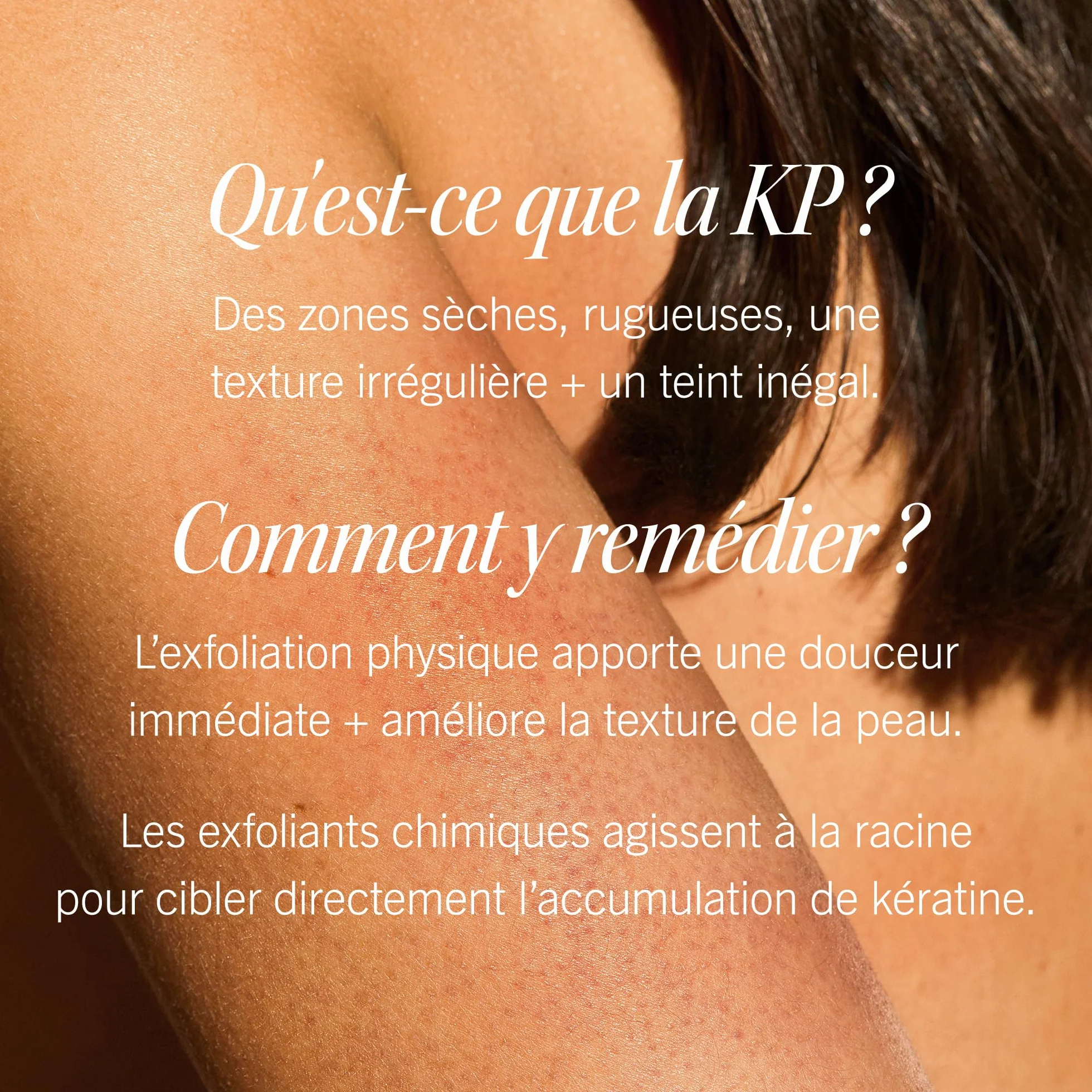 First Aid Beauty Gommage corporel KP Bump Eraser 10% AHA exfoliant kératose pilaire glycolique lactique