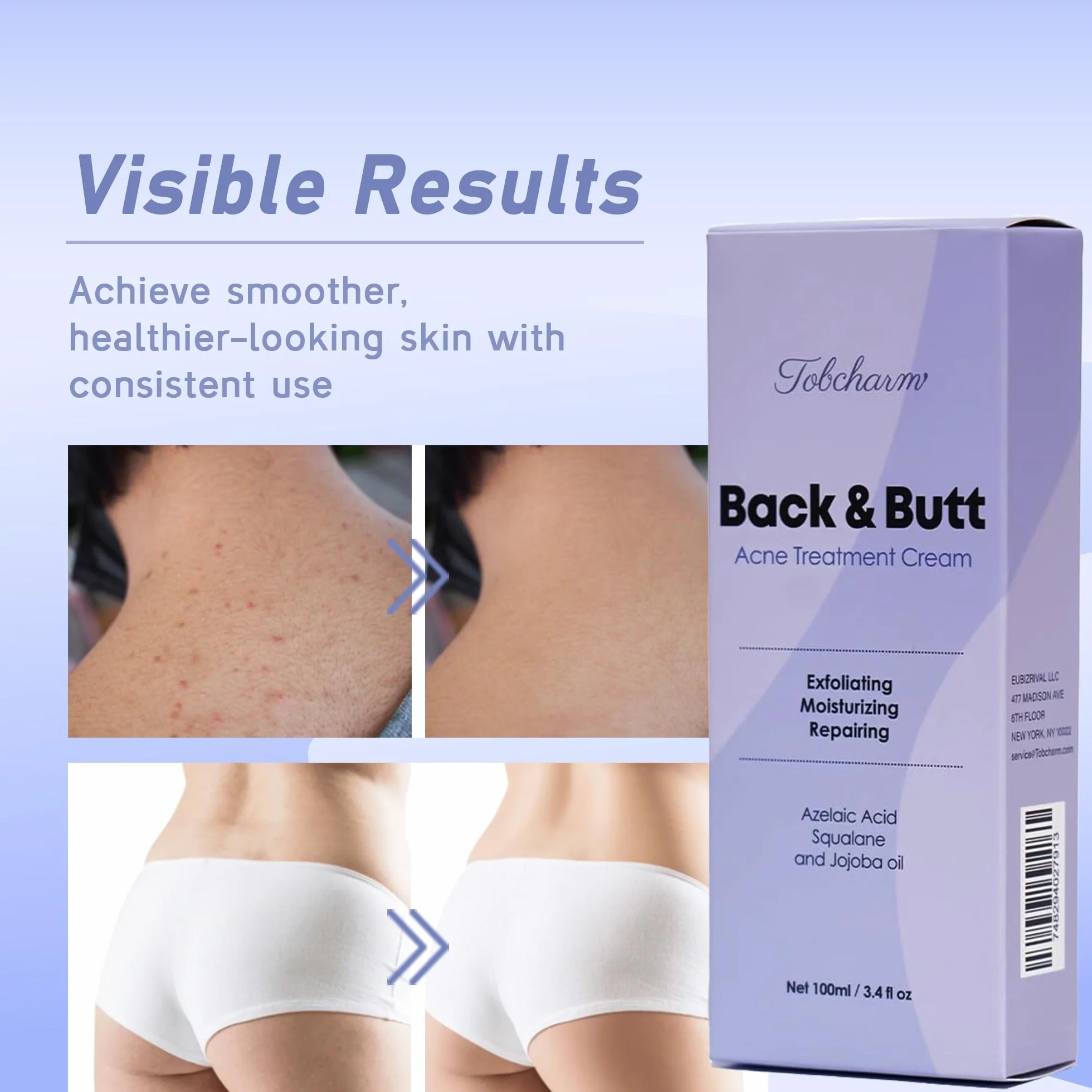 Crème Anti-Acné Tobcharm Acide Azélaïque Traitement Visage Boutons Fessiers Akne Hormonale