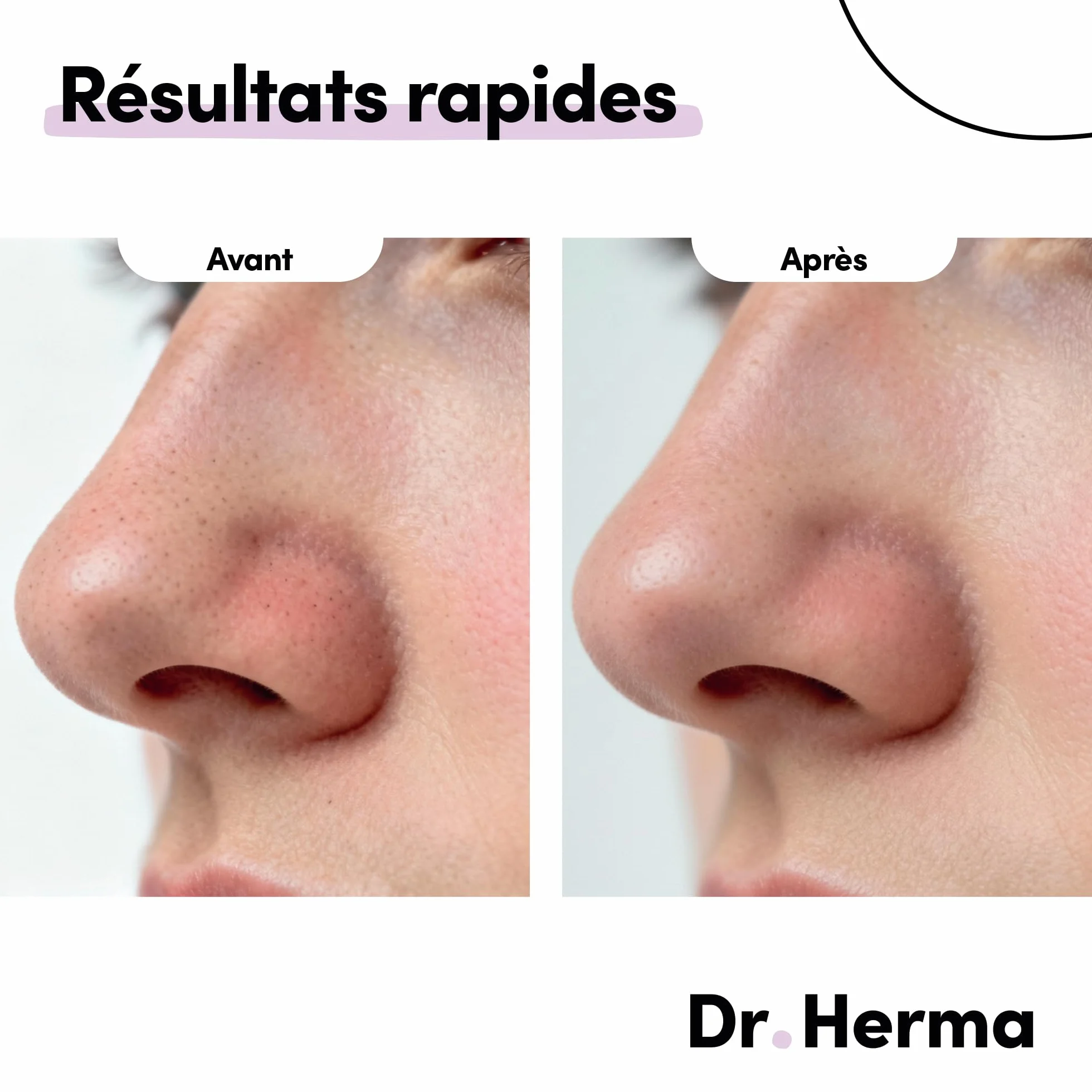 Dr Herma Patch Nez Point Noir 2 étapes Format Nez Purifie Désincruste Ressere les Pores 5 Paires Patch Nasal Anti Imperfection Visage