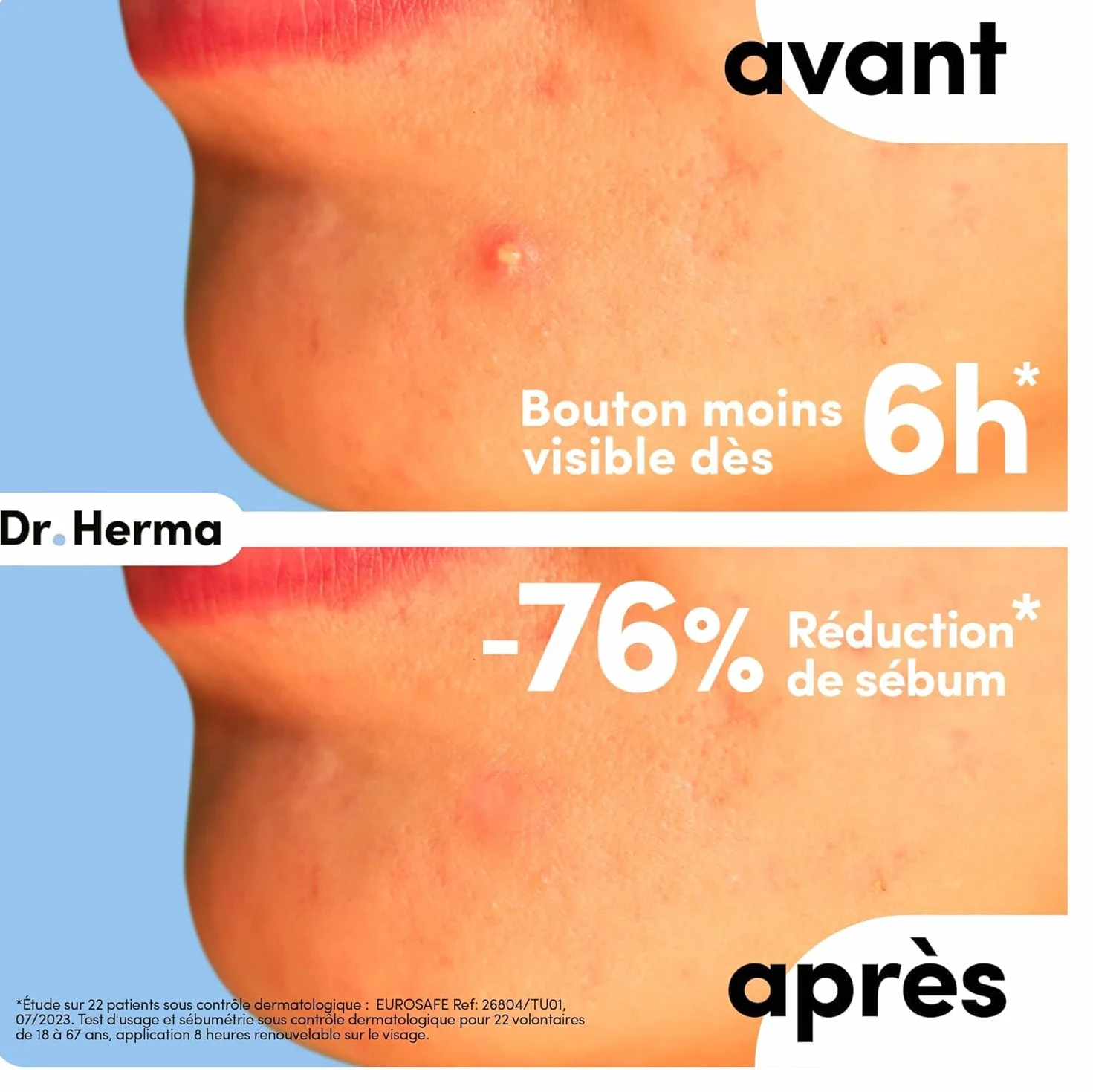 Dr. Herma Patch Anti Bouton Acné Invisible Acide Salicylique Hydrocolloïdes 3 Boîtes de 24 Patchs