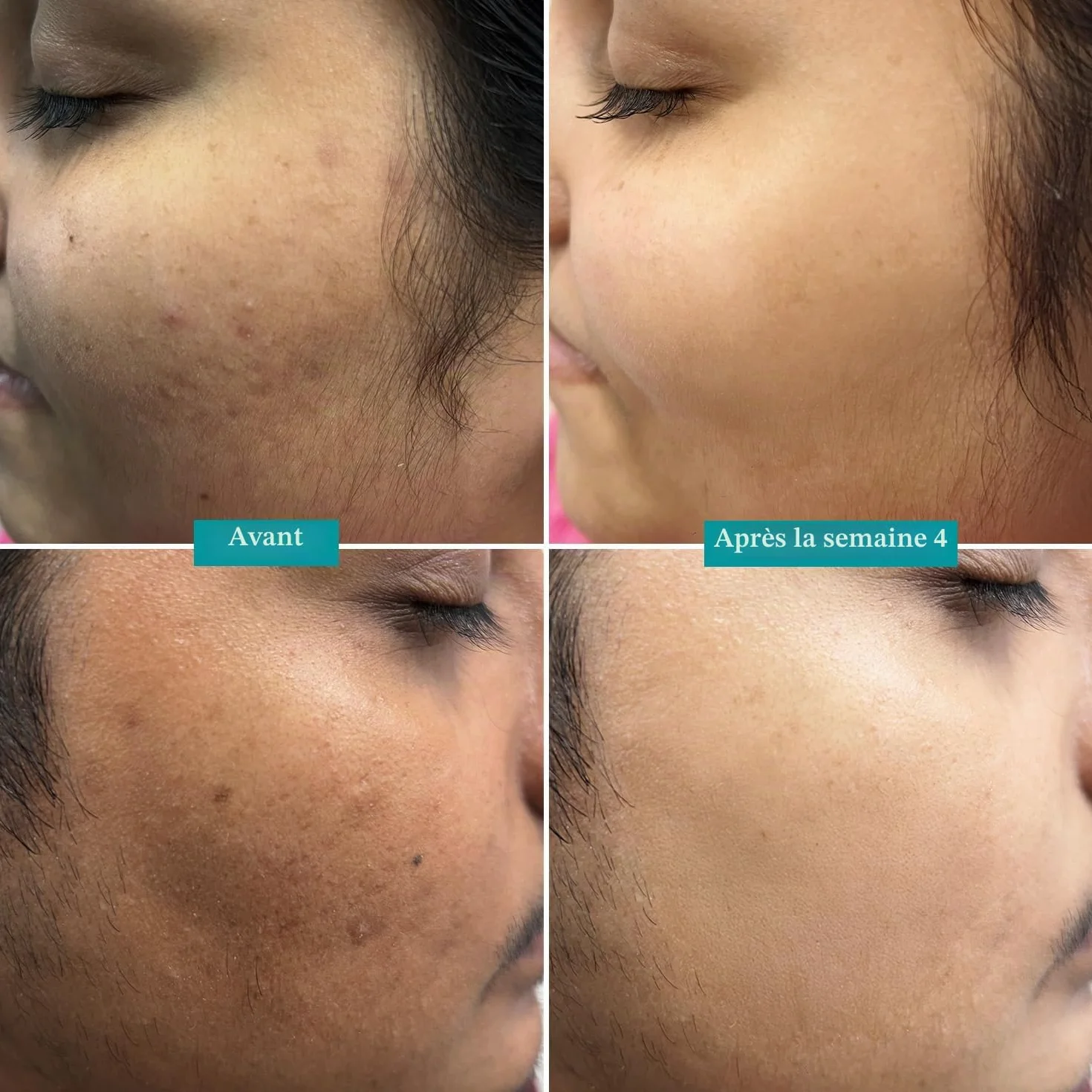 Pilgrim Sérum à 10 % de vitamine C 30 ml pour une peau éclatante | Avec 5 % de niacinamide, acide hyaluronique et glycolique | estompe les taches brunes, la pigmentation | Pour tous, peaux grasses