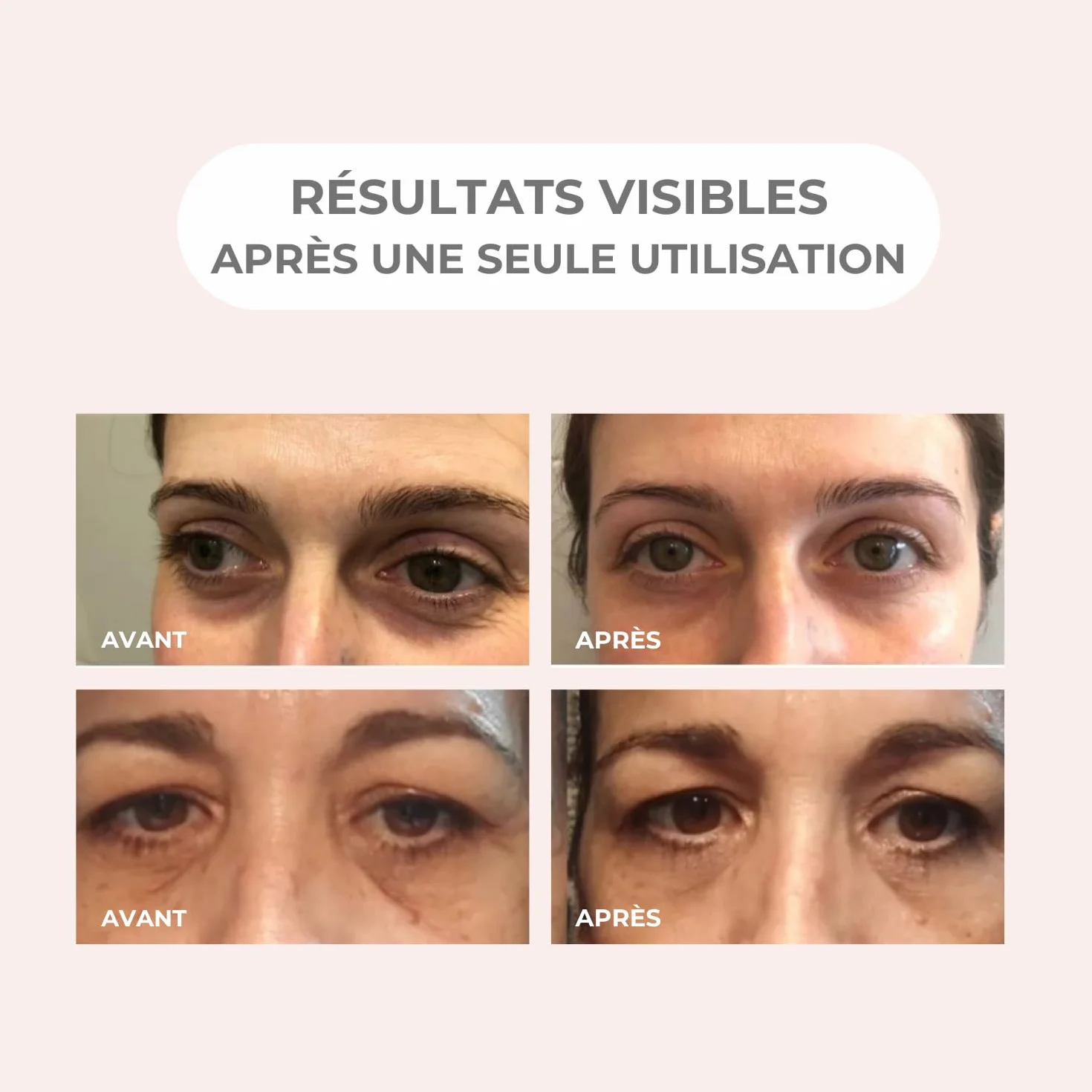 Patchs pour les yeux aux Micro-aiguilles Anti-poches Anti-rides Acide Hyaluronique Peptides 1 paire