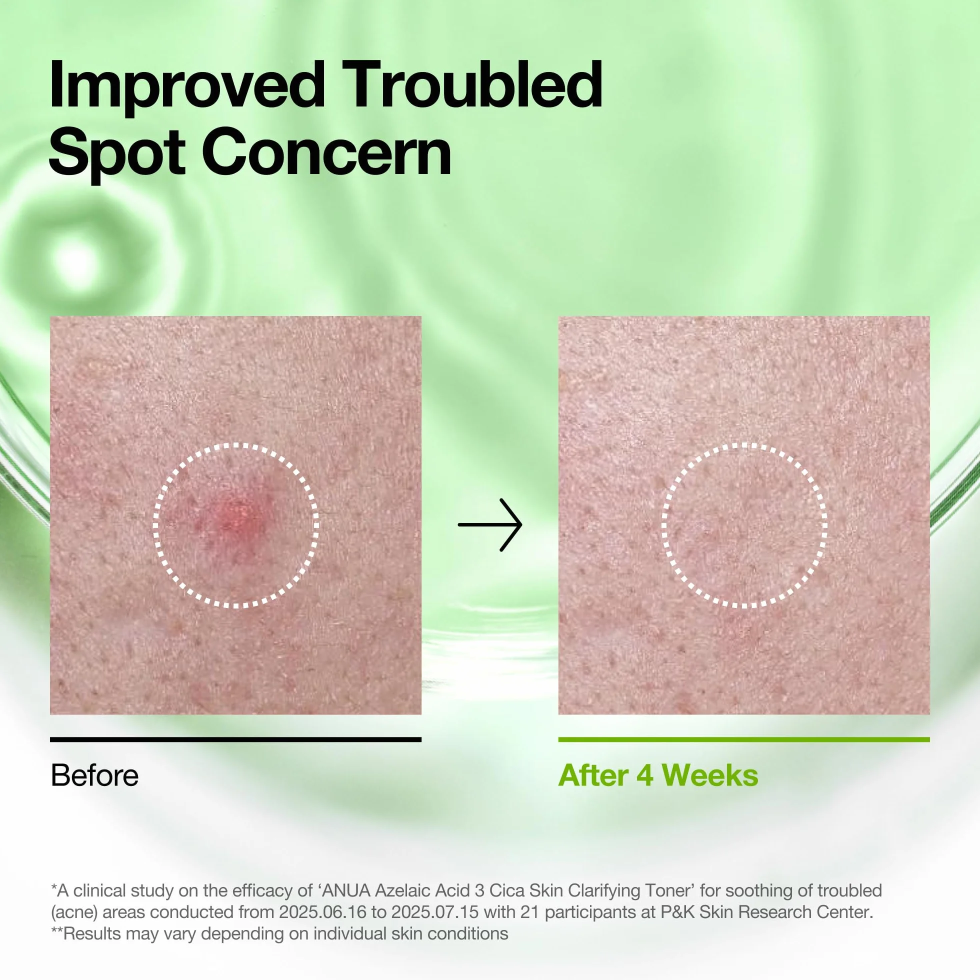 Anua Azelaic Acid 3 CICA Skin Claryfing, tonifiant et transparent, avec acide salicylique et acide azélaïque, sébum & Spot Care, convient aux peaux sensibles, soins de la peau coréenne (250 ml)