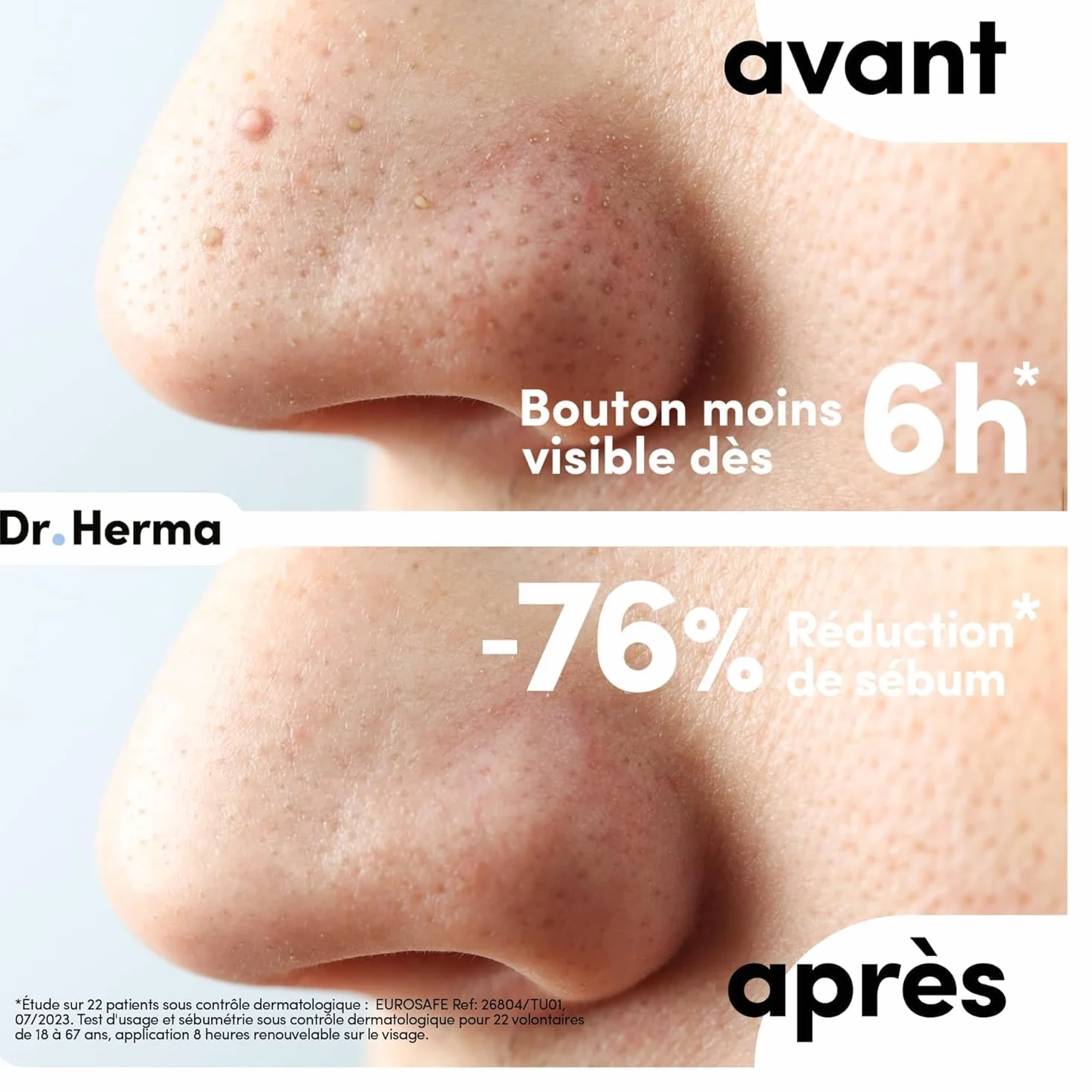 Dr. Herma - Patch Anti Bouton - Adapté au Nez - Résultats en 6 à 8h - Testé sous contrôle dermatologique - Acide Salicylique, Hydrocolloïdes, Huile d'Arbre à Thé - 2 Boîtes de 10 patchs