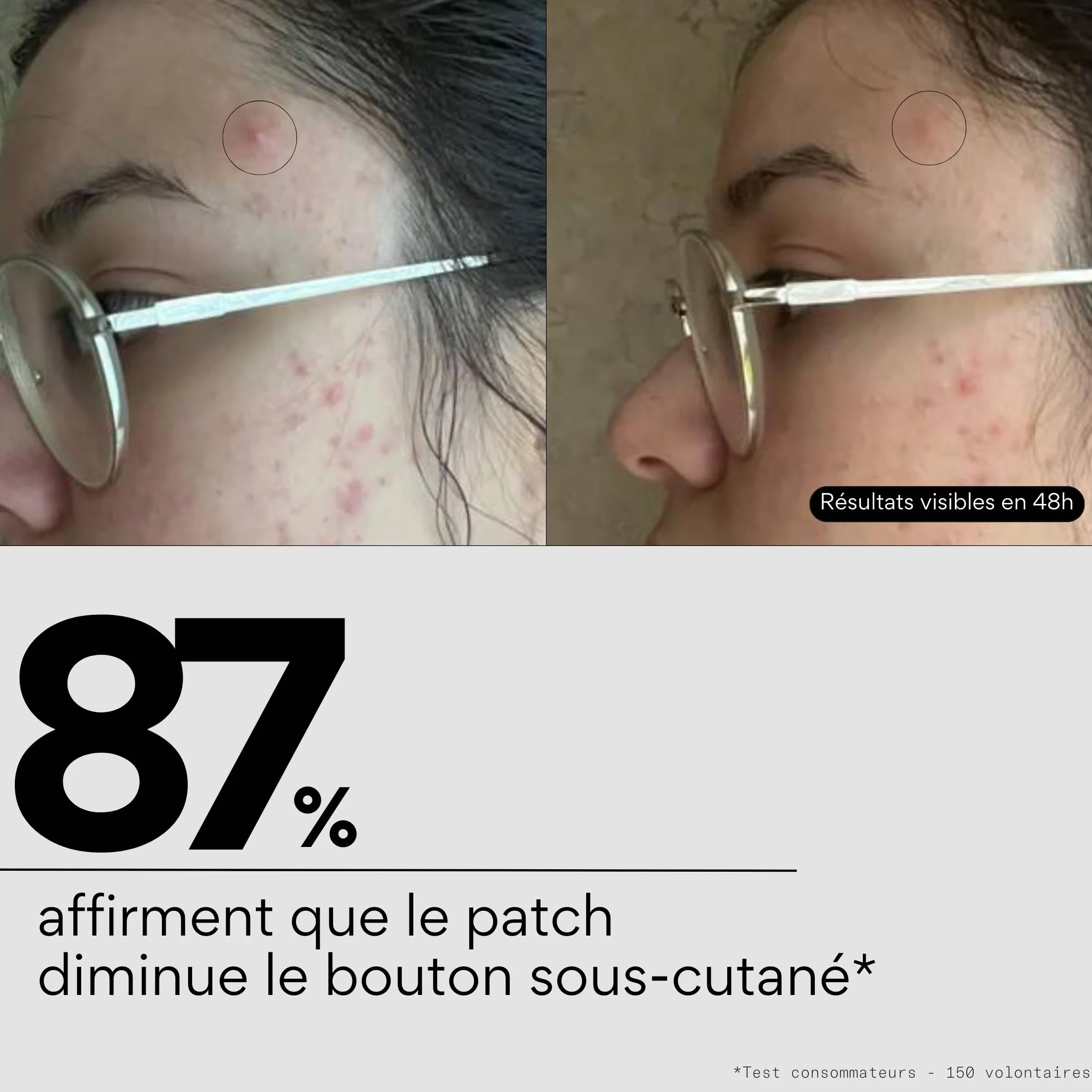Skin & Out Patchs Micro-aiguilles x9 Stop boutons Traitement anti-inflammatoire Yuka 93/100 Vegan