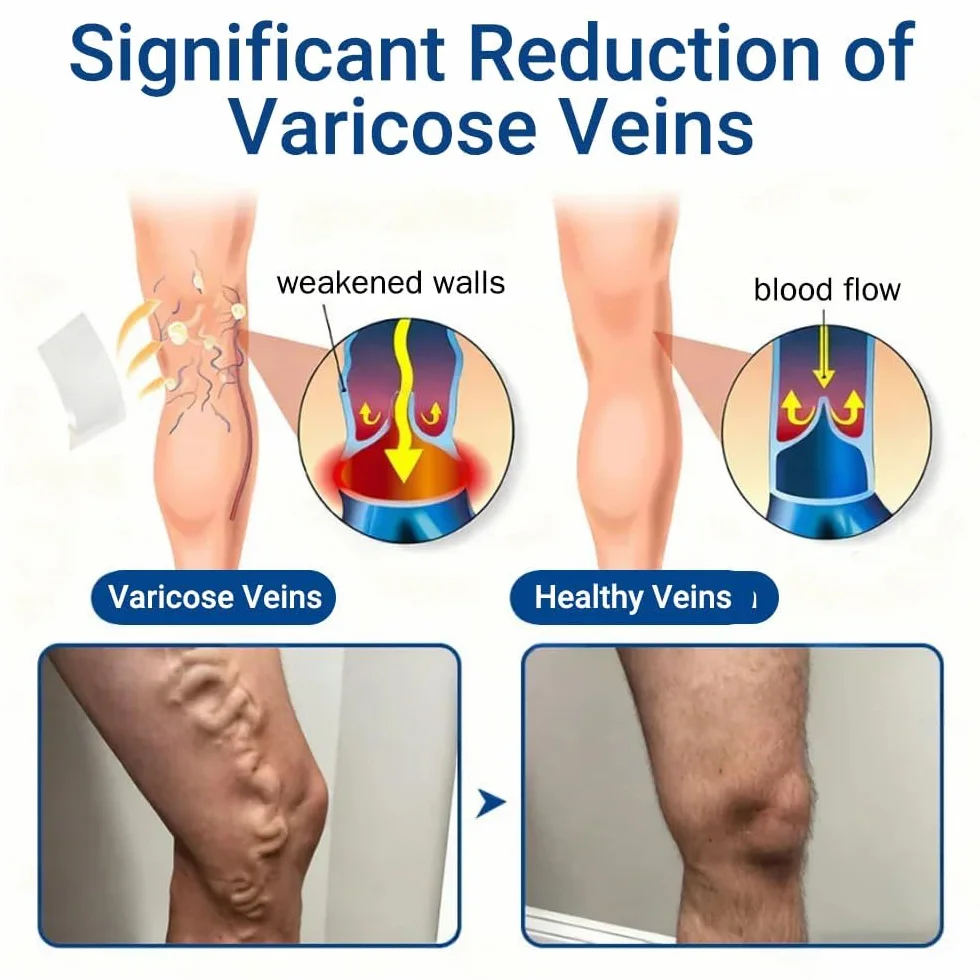 Leg Renew Varicose Vein Patch 60pcs Vein Target Microneedle Patch Natural Ingredients All Skin Types