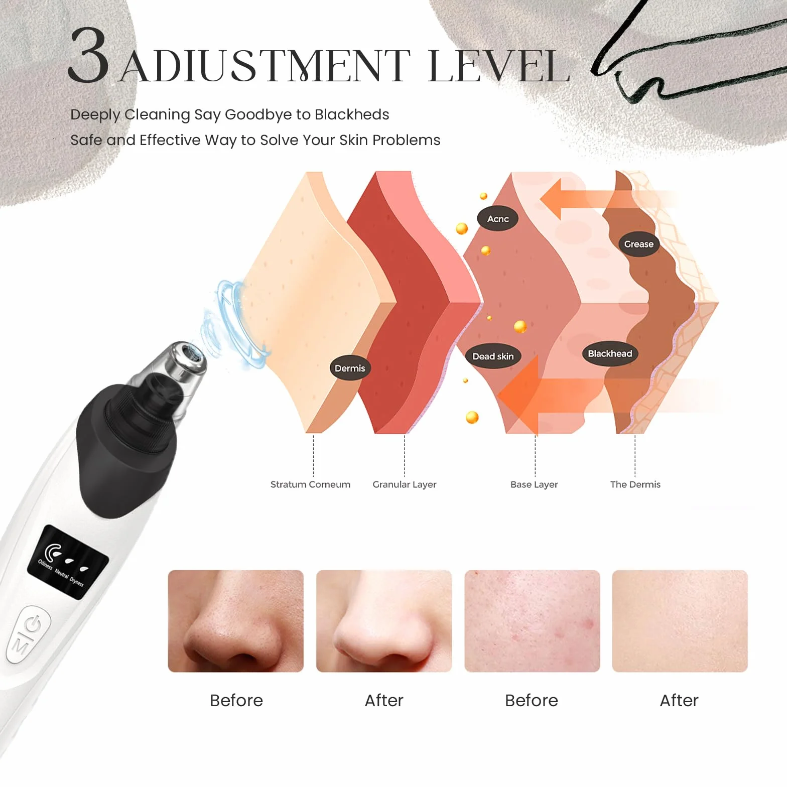Extracteur de points noirs 2024, nettoyeur de pores du visage - 5 puissances d'aspiration, 5 sondes - Kit d'aspirateur électrique rechargeable par USB pour adultes