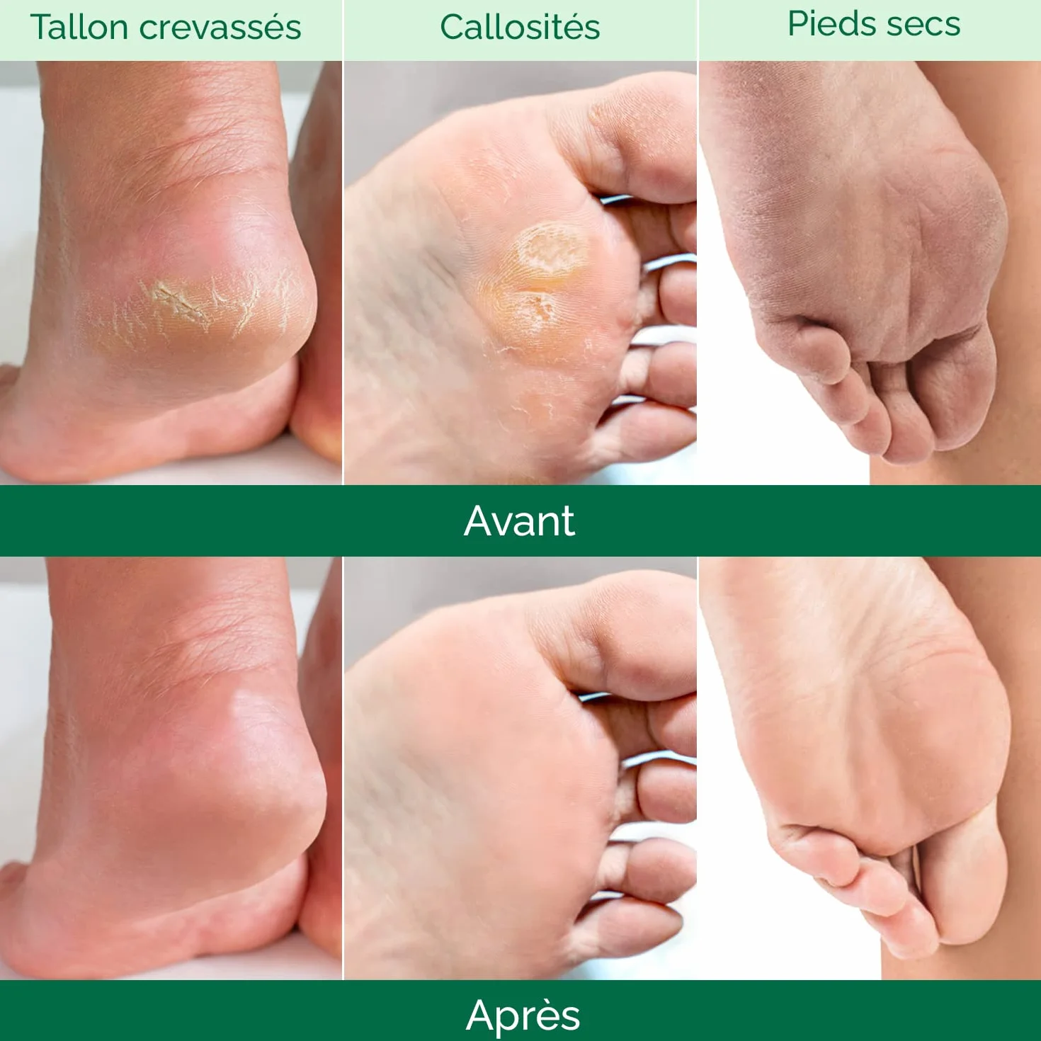 PLANTIFIQUE Masque Pied Peeling Hommes 2 Paires Chaussette Exfoliante Pieds très Secs et Abîmés Gommage Callus Soin Peau Morte