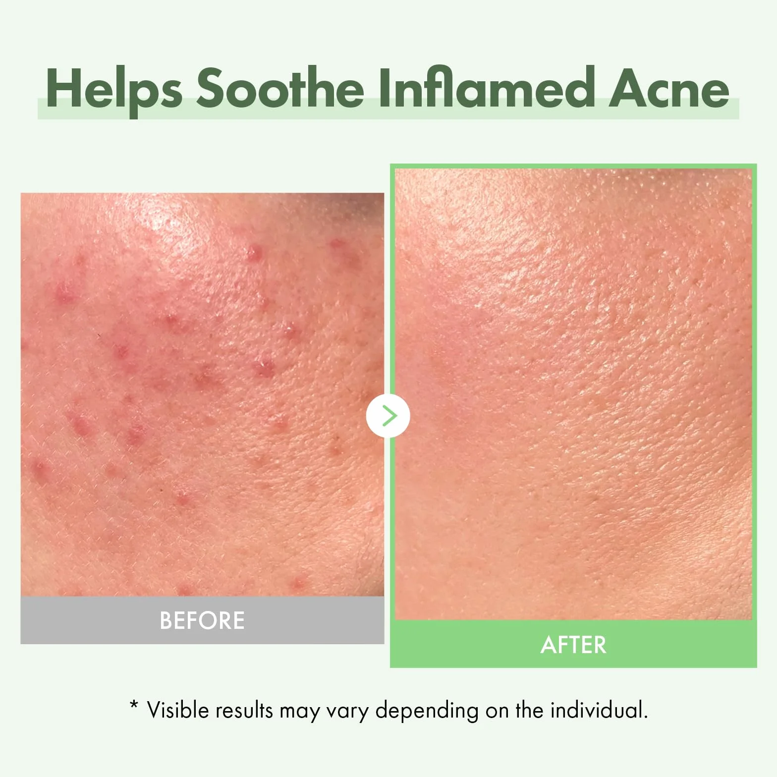 Duo Apaisant & Hydratant : Sérum Visage Acide Azélaïque 10% & Ampoule Real Relief Noni TOSOWOONG pour une Peau Claire et Éclatante