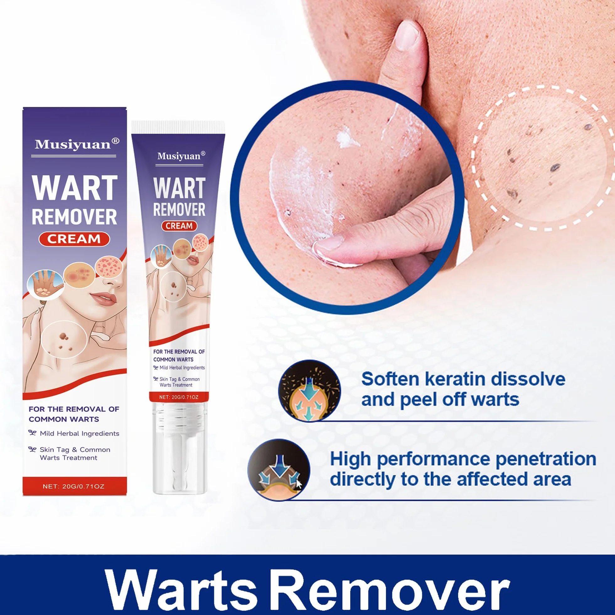 Crème anti-verrues 20 g élimine verrues communes et plantaires mains pieds corps