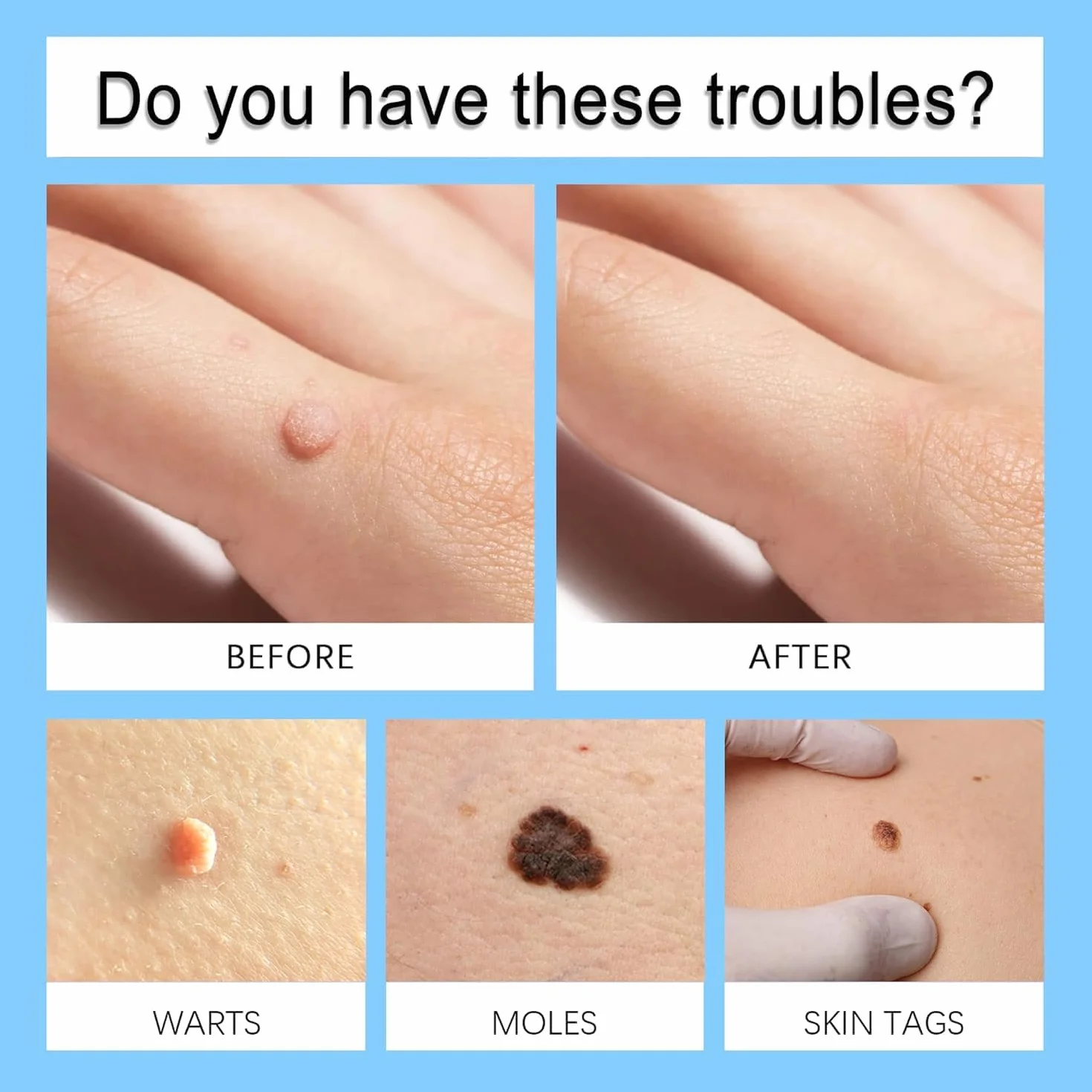 Crème anti-verrues 20g pour acrochordons et petites verrues mains et pieds