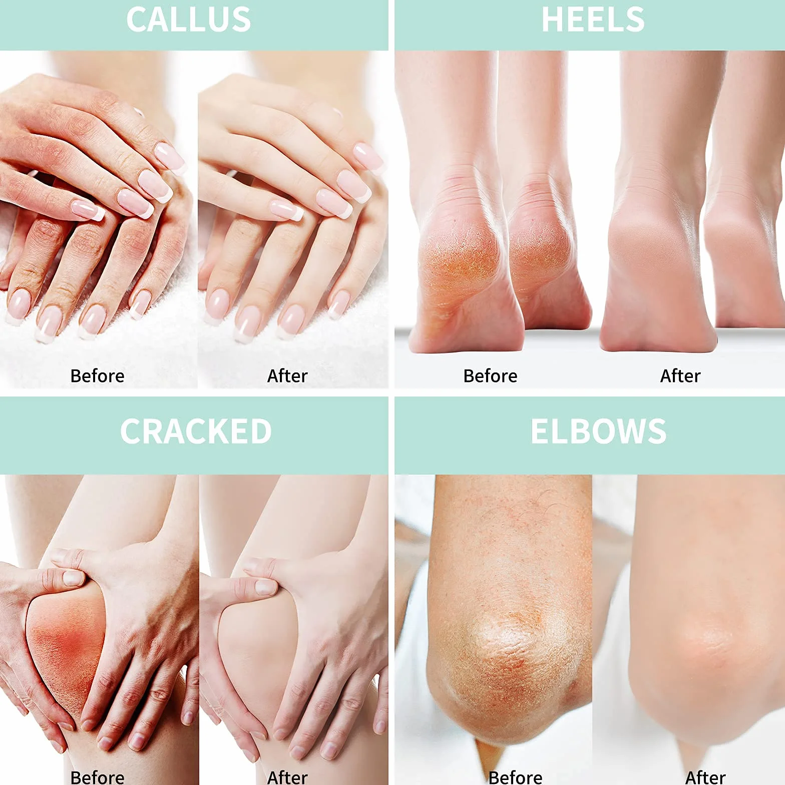 Crème à l'Urée 40% Acide Salicylique Pieds Mains Hydrate Élimine Callosités Adoucit 150 g